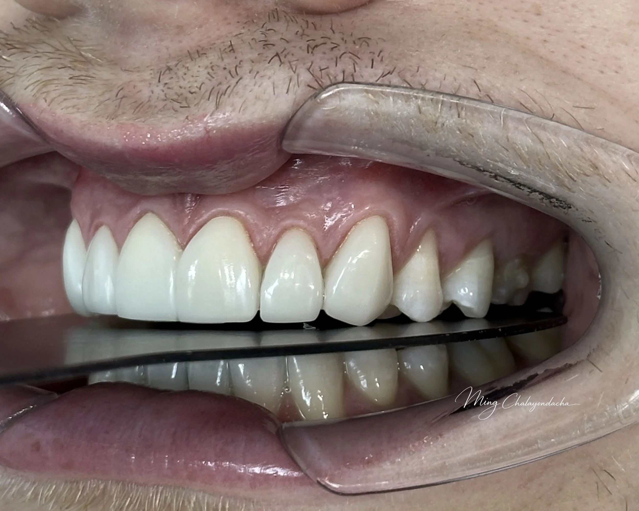 Close-up of a person's mouth with upper teeth showing, a metal dental tool pulling back the lips, and visible facial hair.