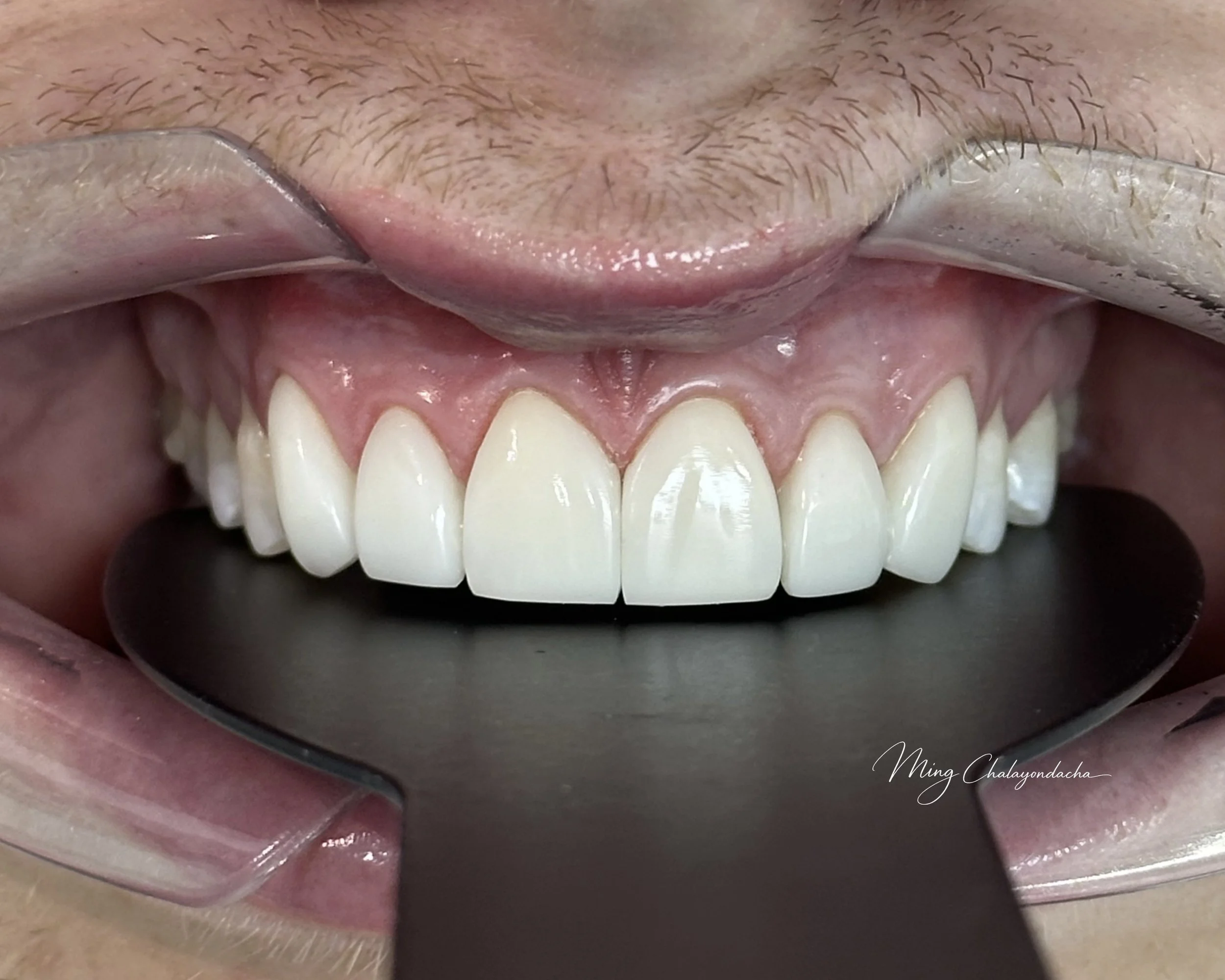 Close-up of a person's mouth showing upper teeth while holding a dental mirror reflecting the upper teeth and gums.