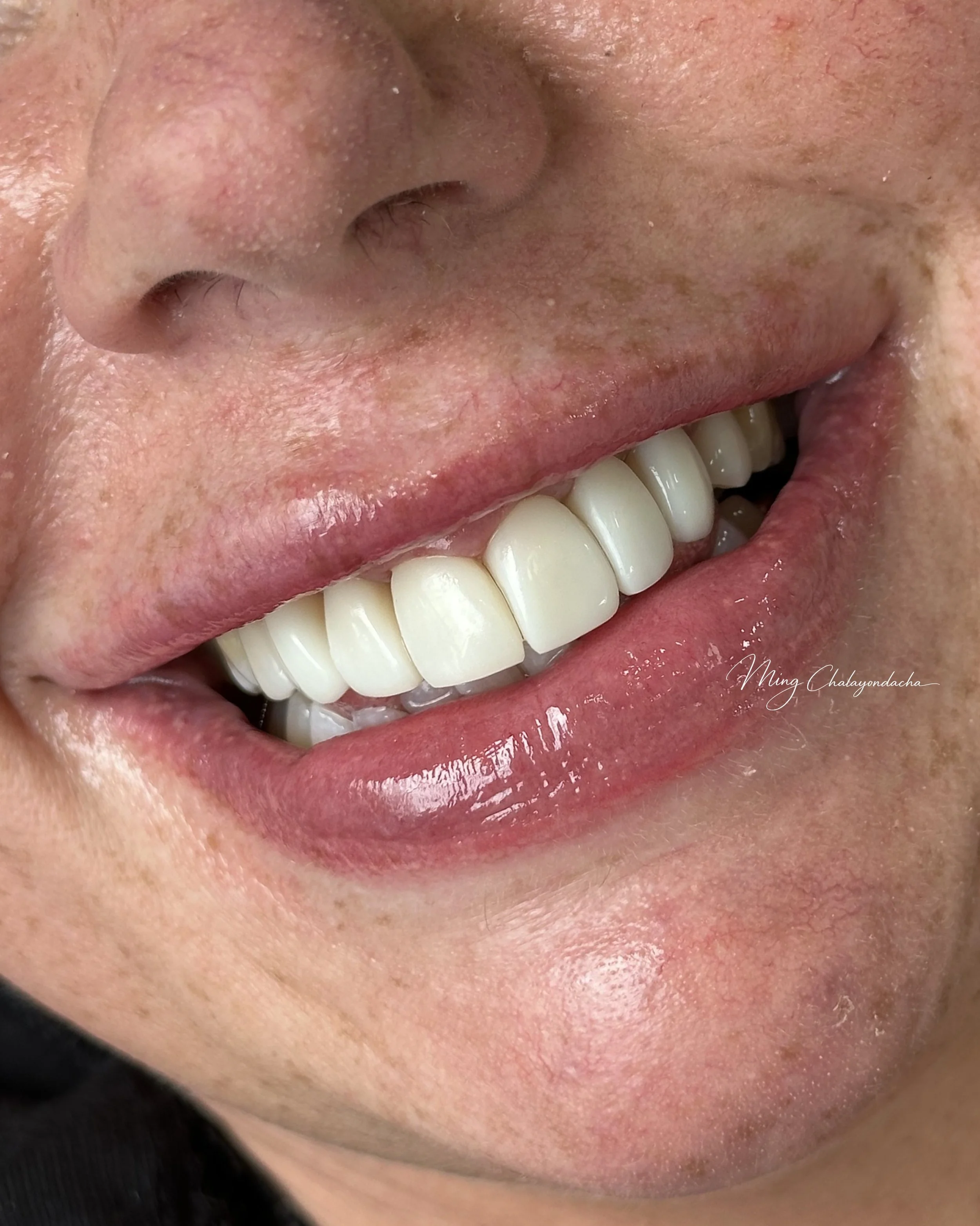 Close-up of a person's smiling mouth revealing straight, white upper teeth and a partially visible lower lip.