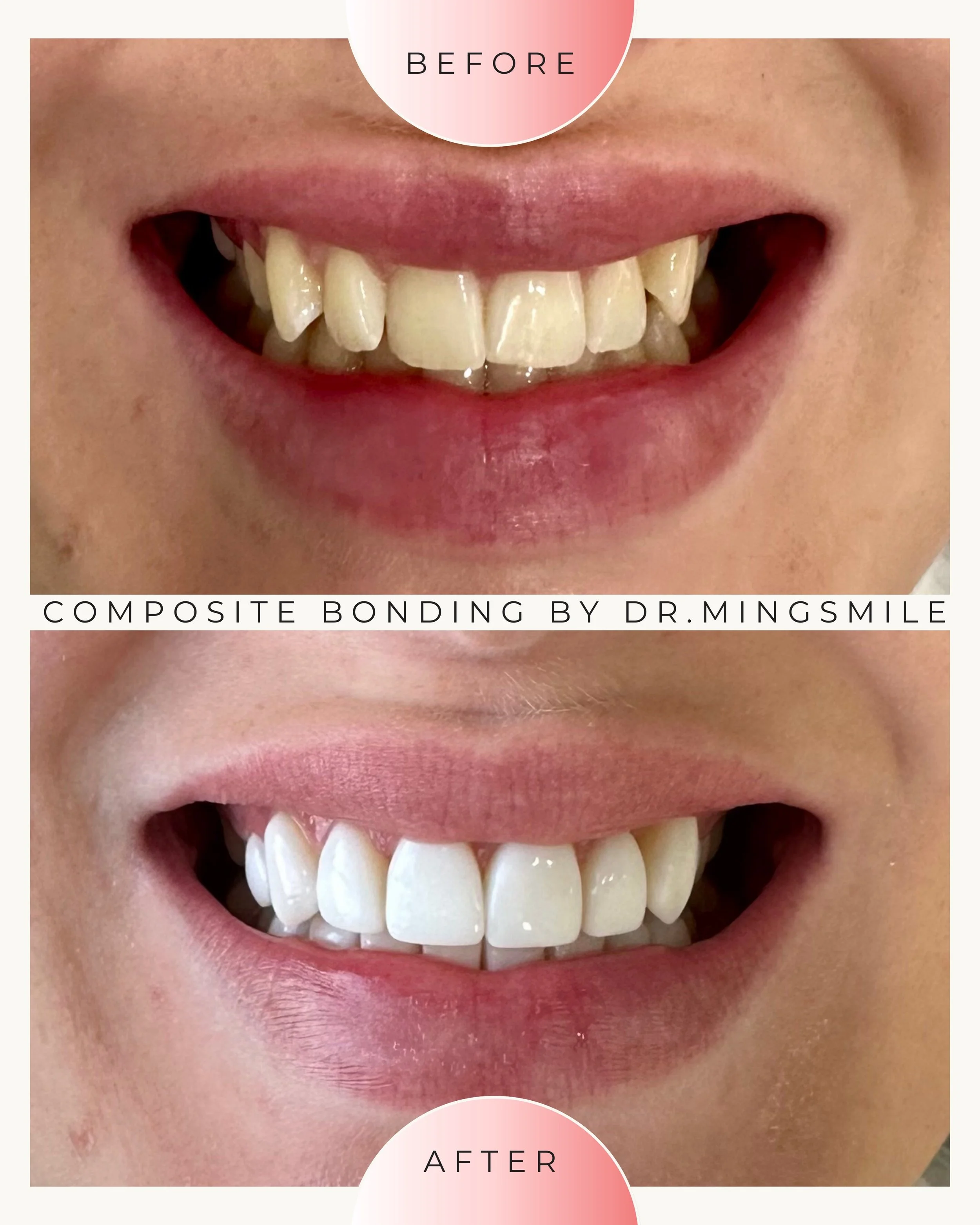 Close-up of a person's mouth showing before and after results of composite bonding dental procedure. The before image shows uneven and chipped teeth, while the after image displays smooth, evenly shaped, and white teeth.