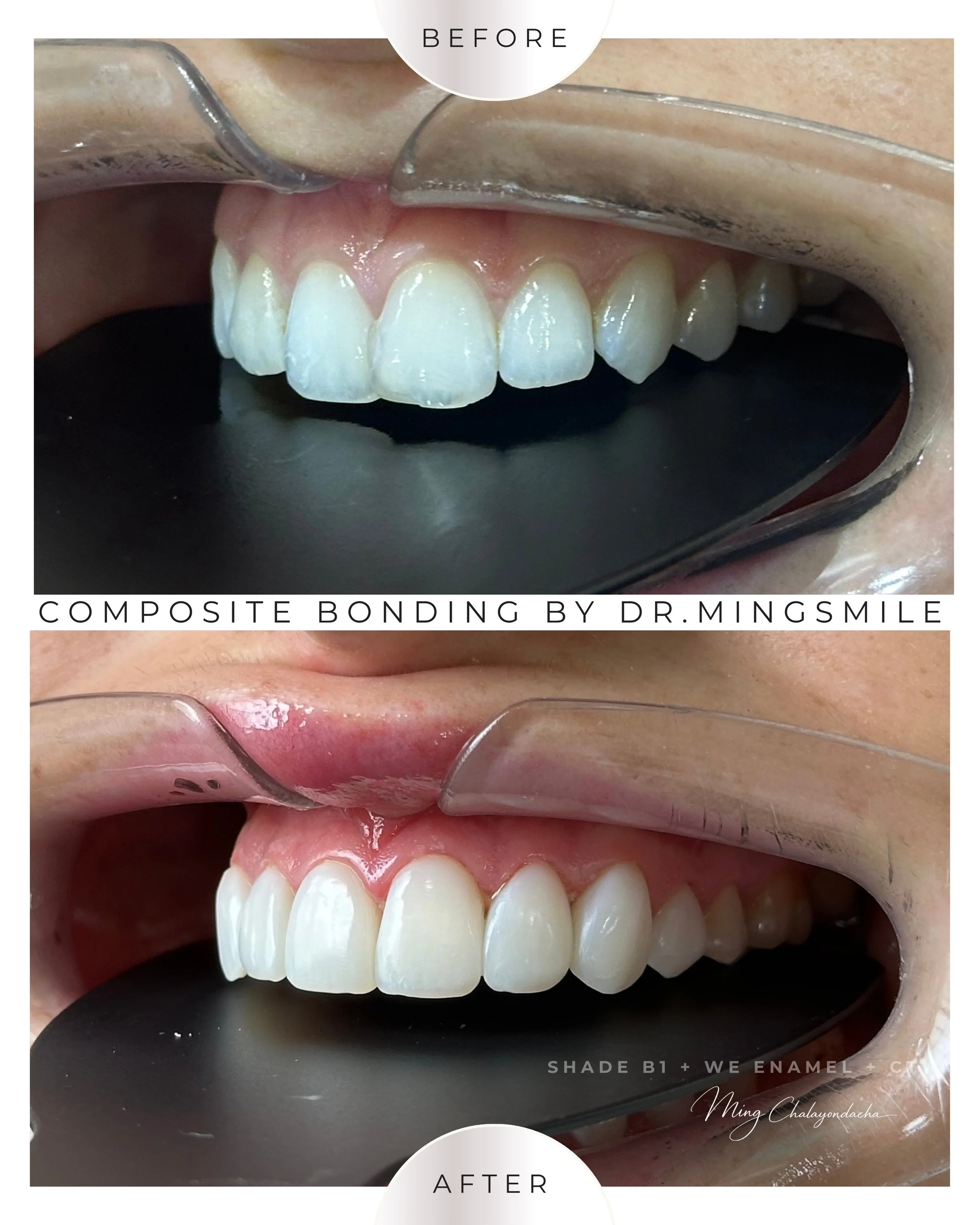 composite bonding  thailand bangkok krabi