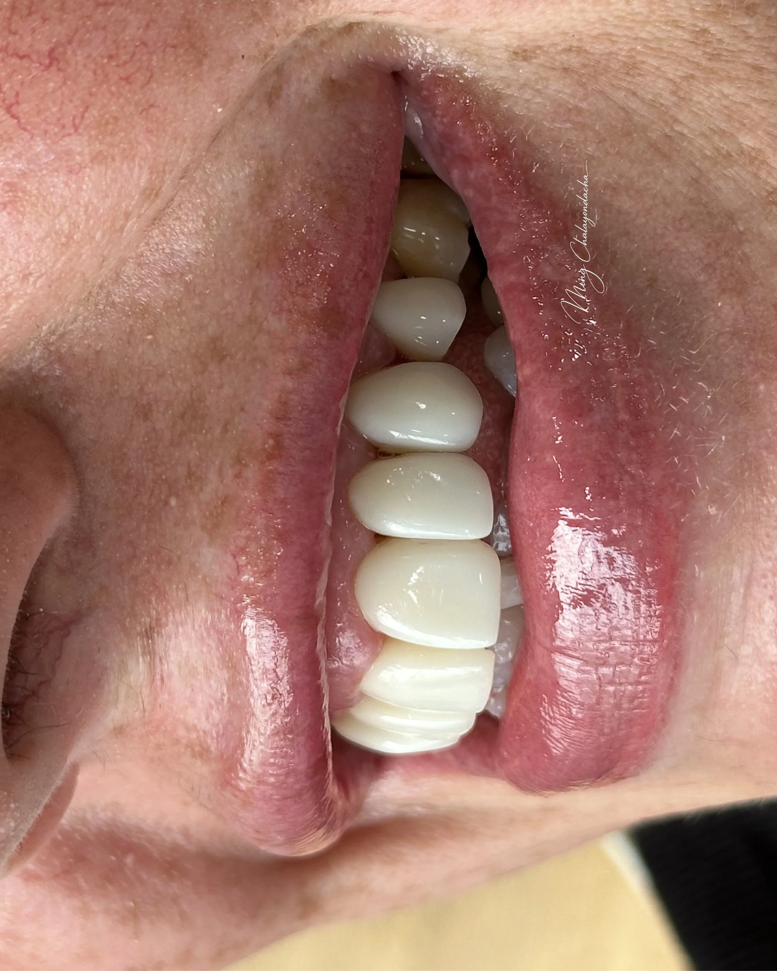 Close-up of a person's open mouth showing teeth and pink gums, with a focus on the molars and tongue inside the mouth.