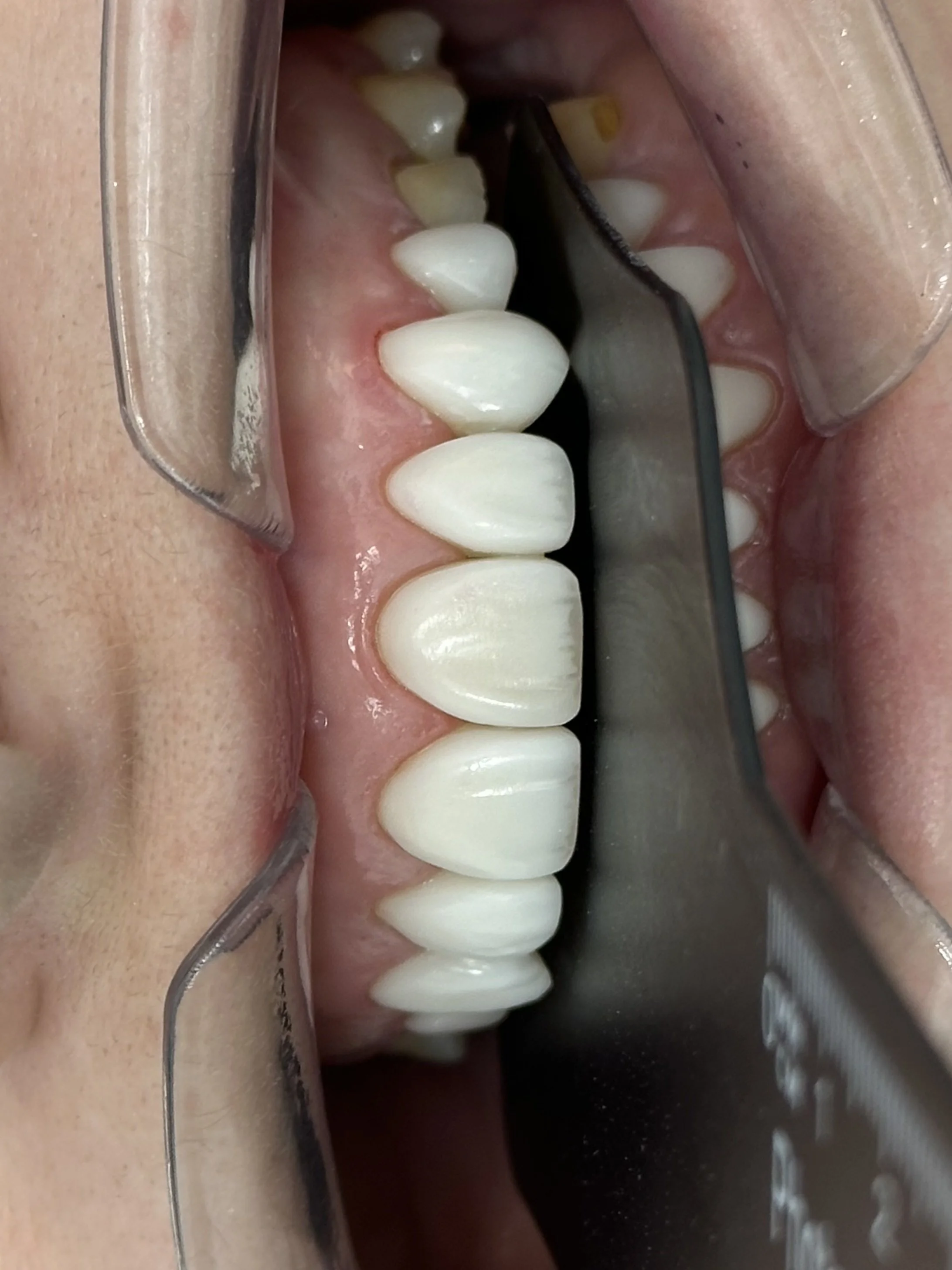 Close-up of a person's mouth showing teeth, with dental tools and a mirror during a dental procedure.
