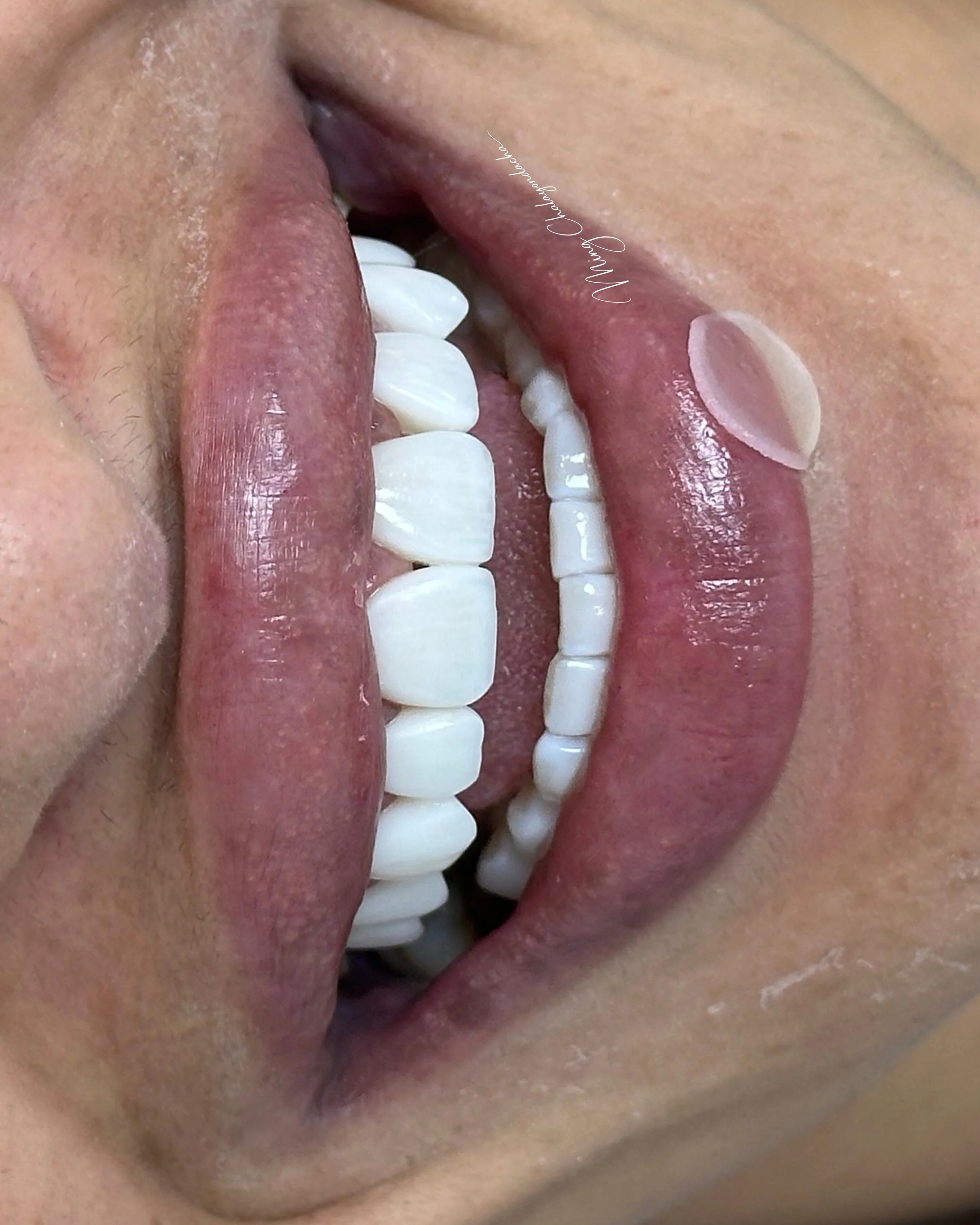 Close-up of a person's mouth with lips, teeth, and tongue visible, with a small round object on the lower lip.
