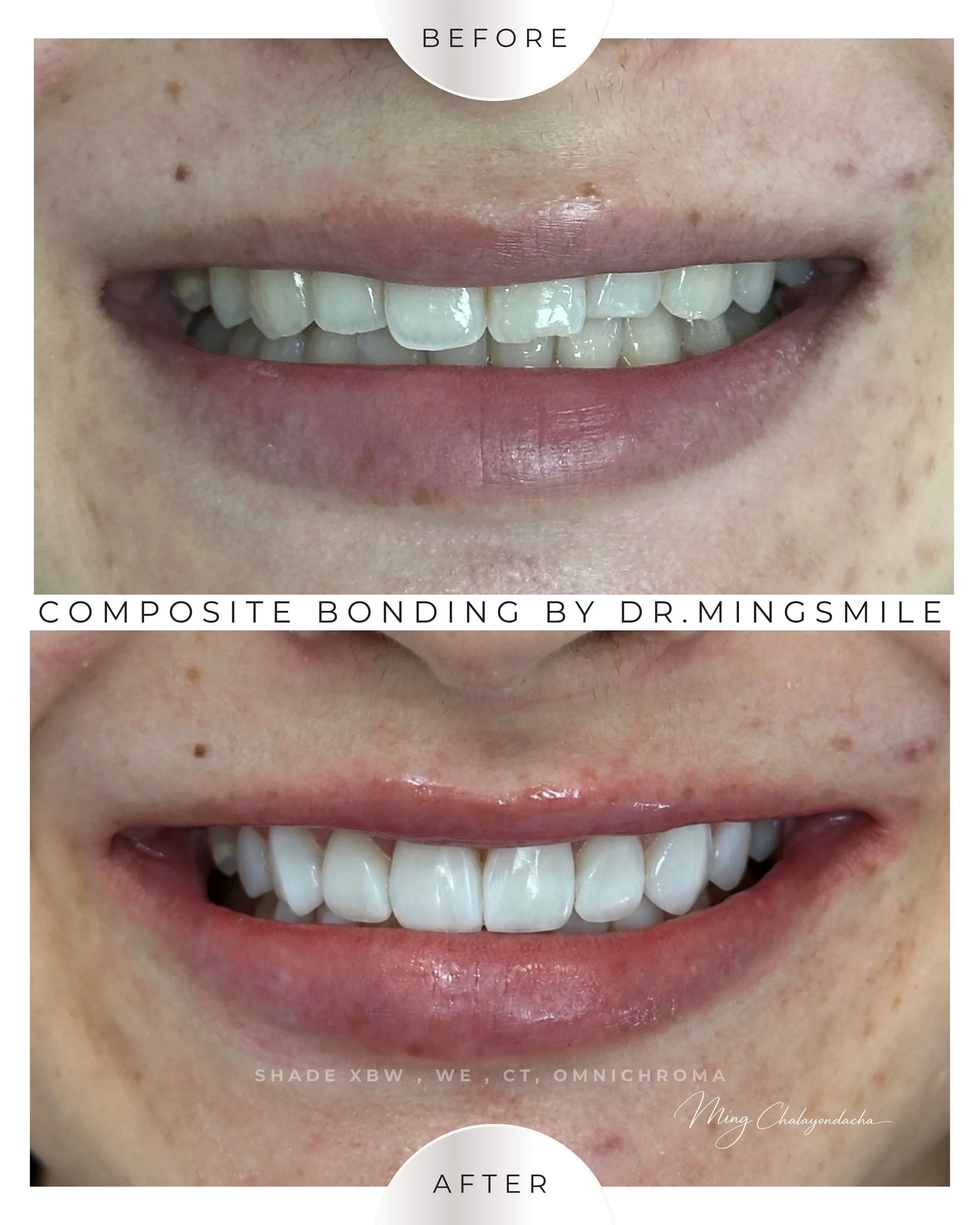 Close-up of a person's smile showing their teeth before and after dental composite bonding treatment. The 'Before' image shows teeth with uneven coloring and minor imperfections, while the 'After' image displays teeth that are whiter, smoother, and m