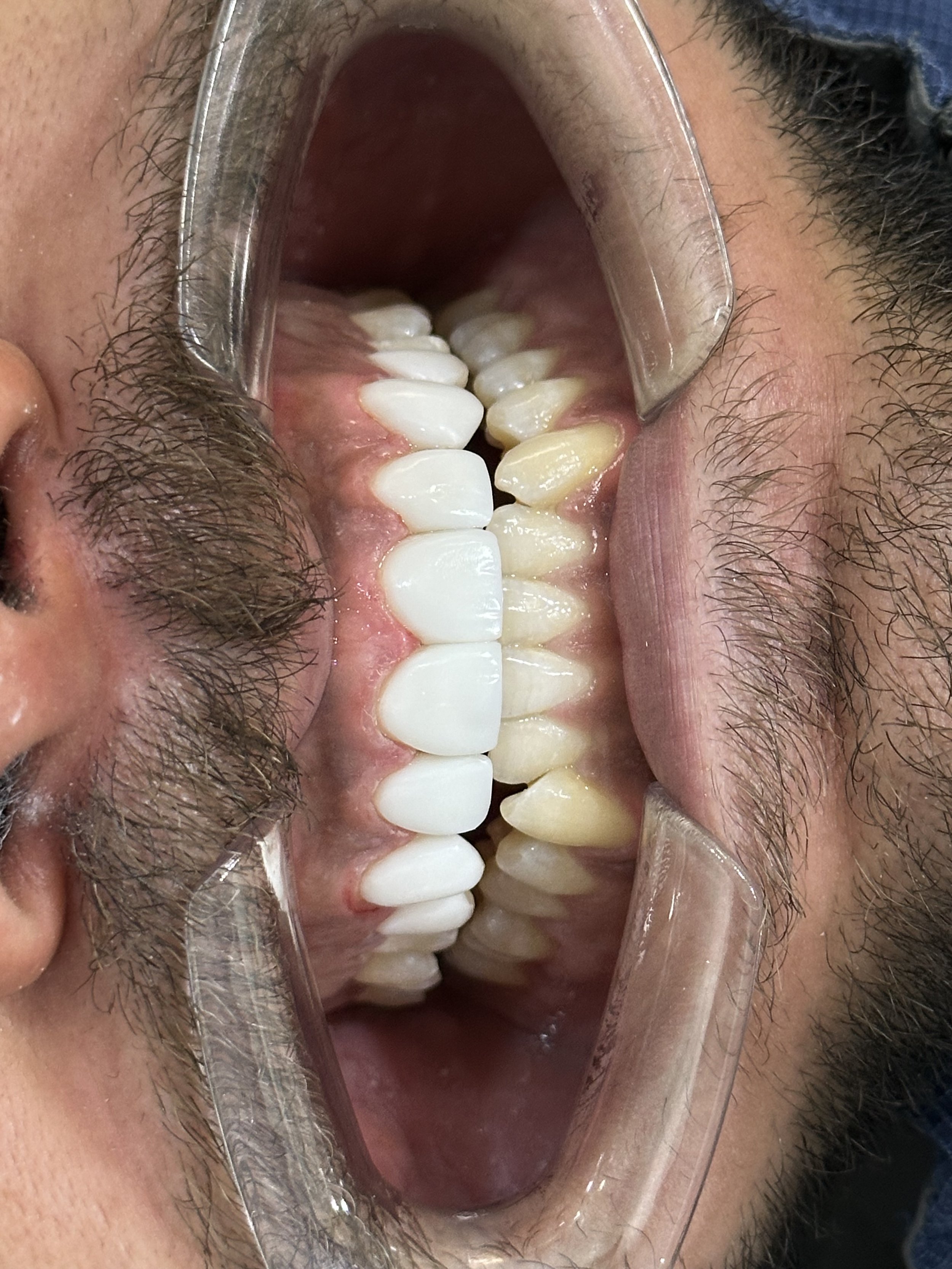 Close-up of a person's open mouth with teeth and gums visible, held open with a dental tool.