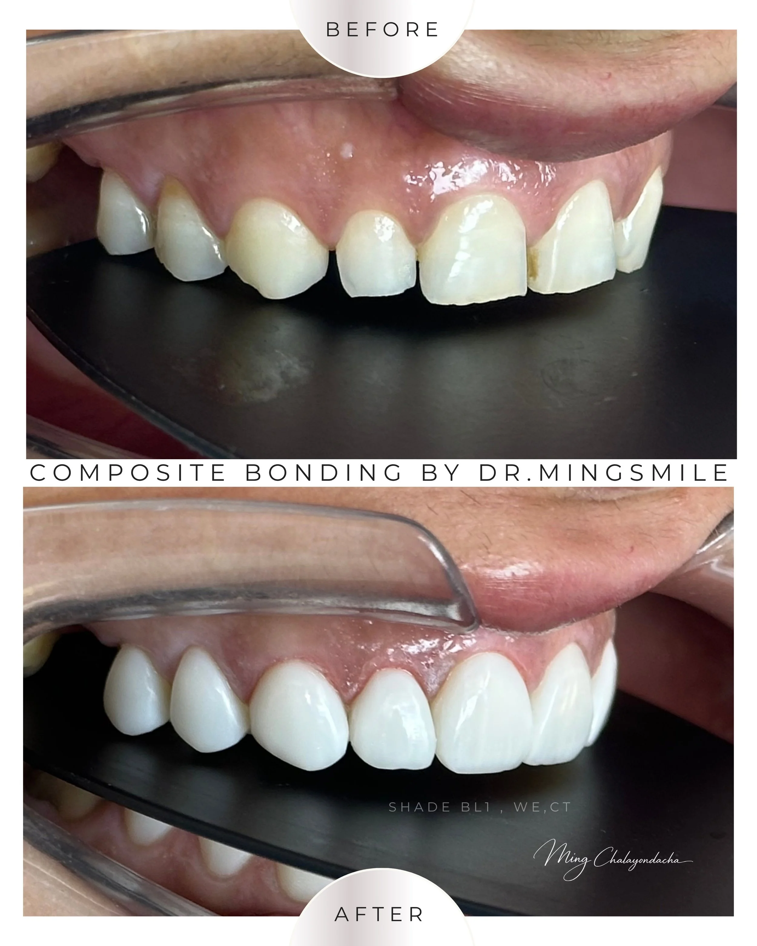 composite bonding  thailand bangkok krabi