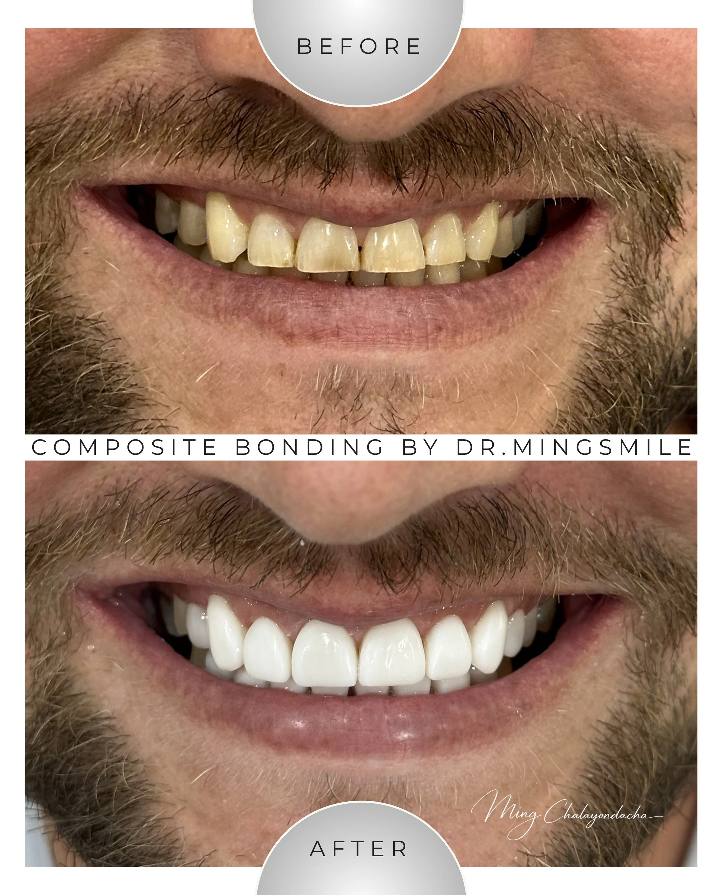 Close-up of a person's smiling mouth showing before and after dental composite bonding results on upper teeth, with the after image displaying whiter, straighter teeth.