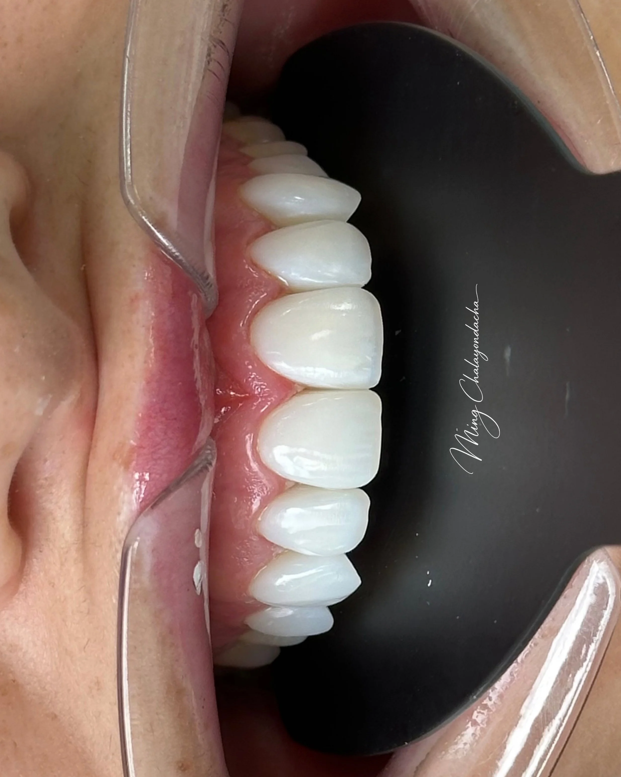 composite bonding 
