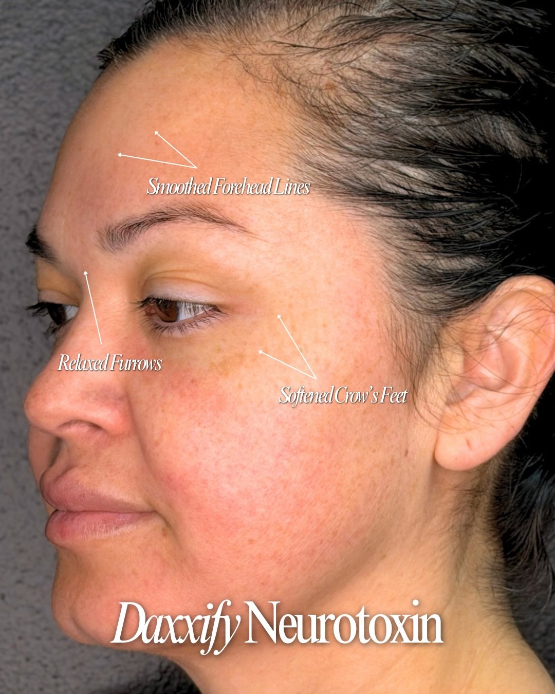 Relaxed muscles, softened lines, and long-term results with Daxxify Neurotoxin Treatment ✨ The treatments are quick, comfortable, and require little to no downtime, making it easy to fit into your routine. 🖤

Book a Free Consultation now on MadnessA