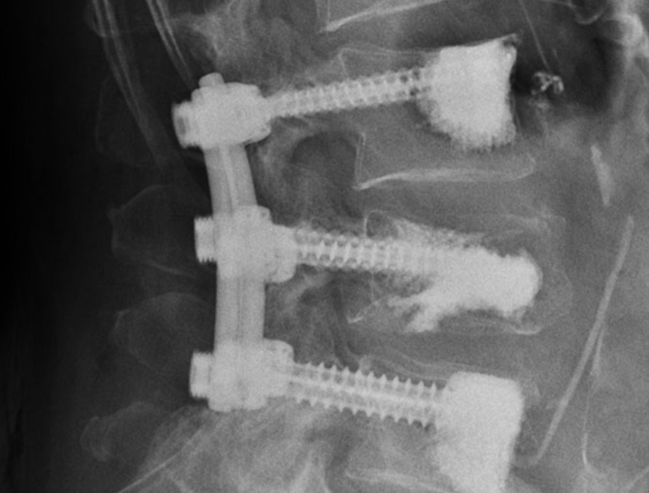 X-ray image showing spinal fusion with three metal screws and rods.