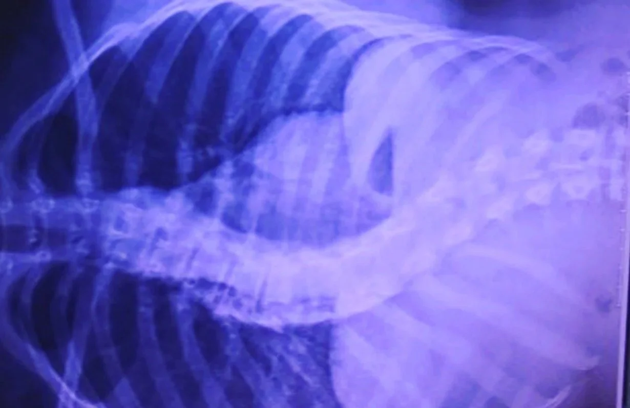 X-ray image of a human chest showing ribs and spine in purple and blue tones.