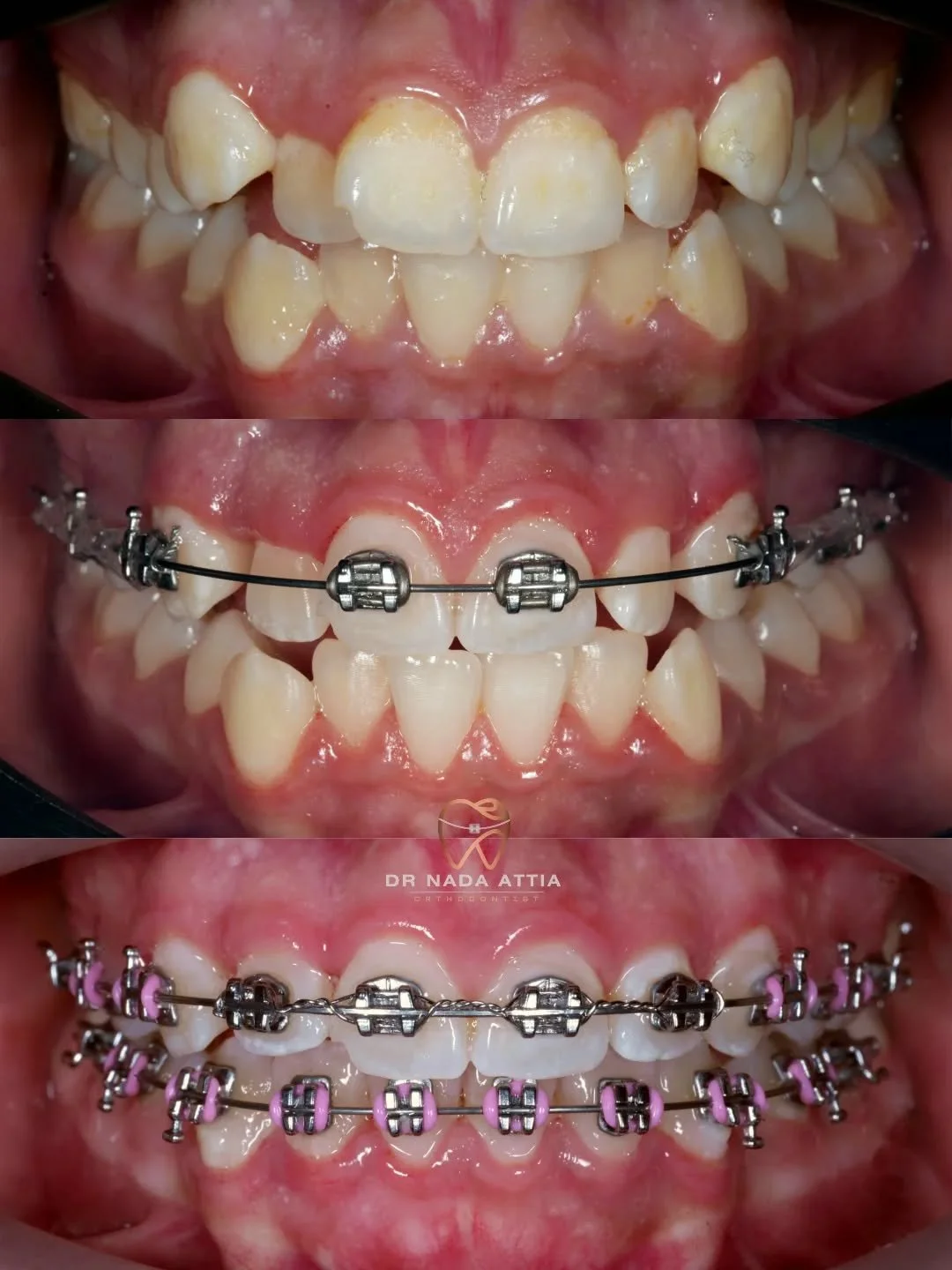 Close-up of teeth before, during, and after orthodontic braces treatment showing alignment progress.
