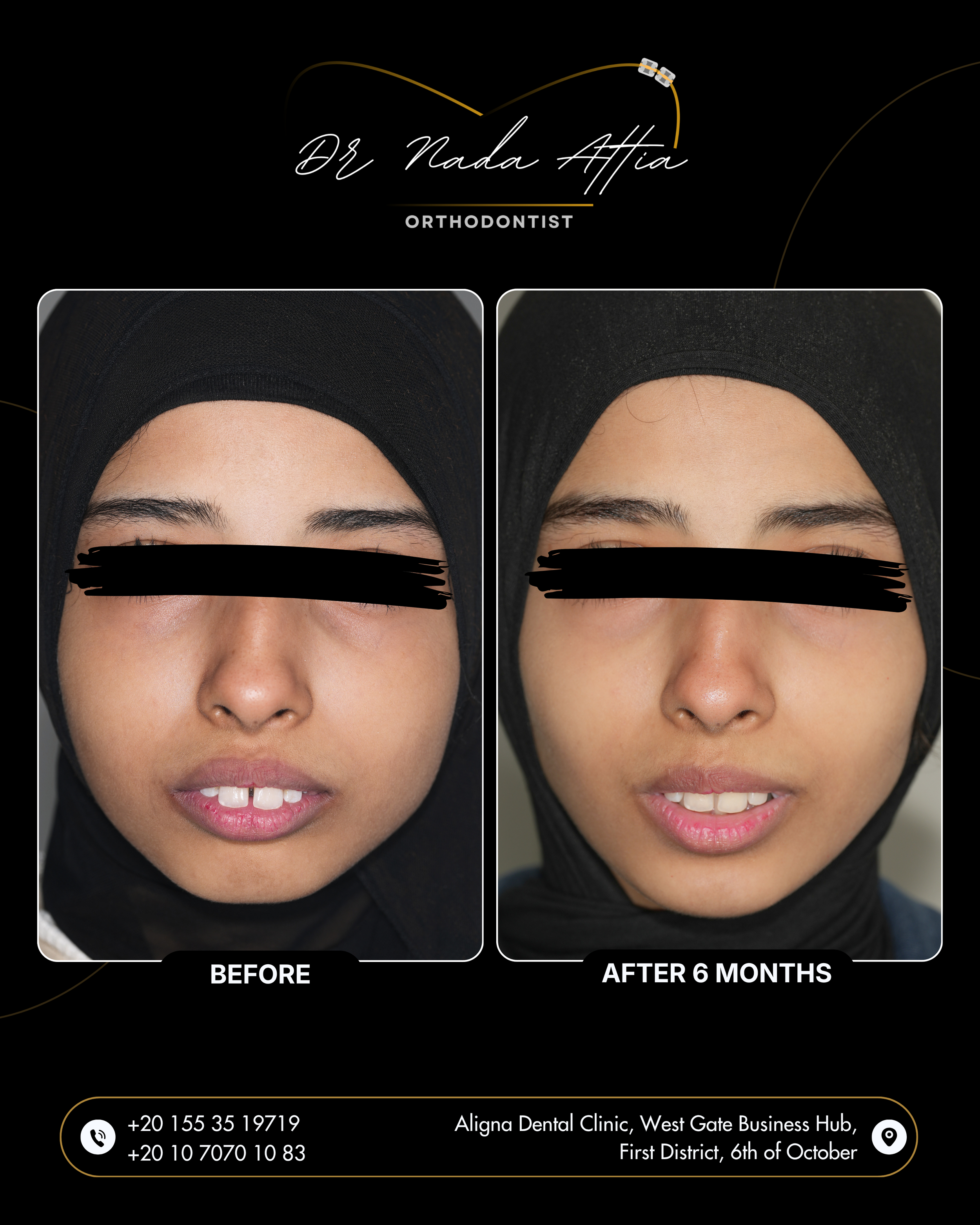 Comparison of a woman's teeth before and after 6 months of orthodontic treatment, showing improved alignment and appearance.