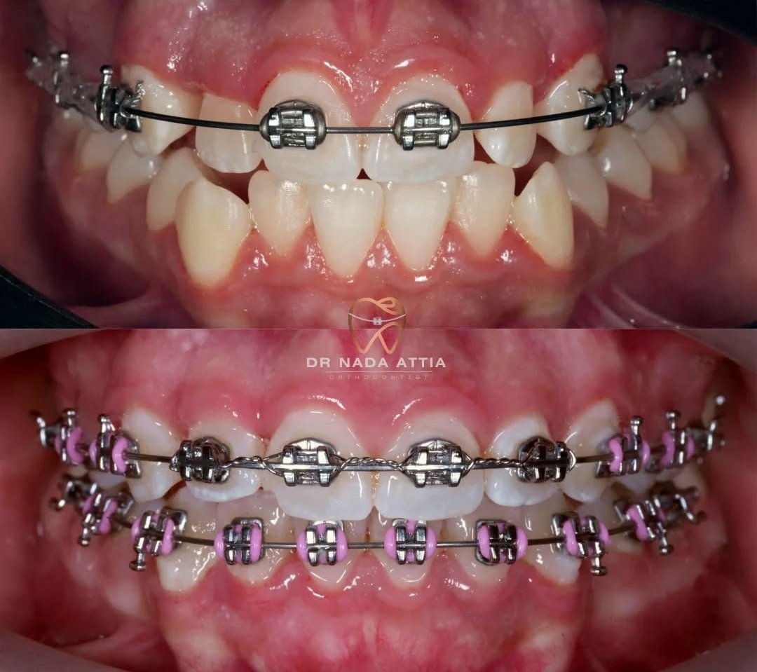 Close-up of a person's teeth with braces before and after orthodontic treatment; top image shows metal braces before, bottom image shows metal braces with pink elastic bands after.