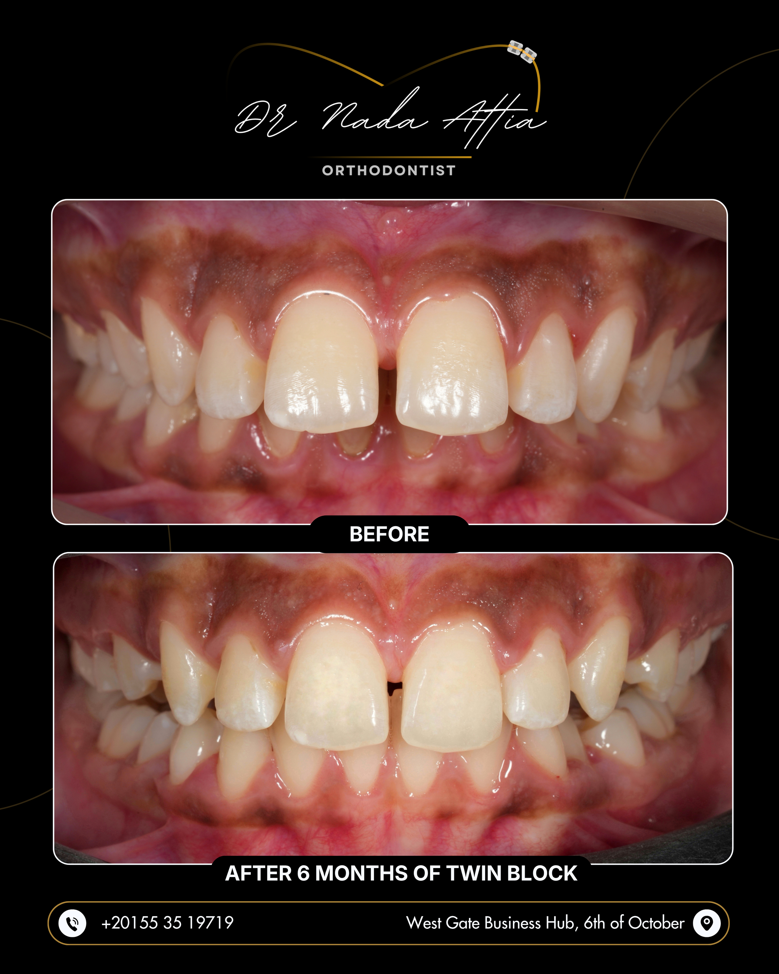 Close-up of a person's teeth and gums showing the before and after results of orthodontic treatment, with the after photo labeled 'AFTER 6 MONTHS OF TWIN BLOCK' and the before photo labeled 'BEFORE'.