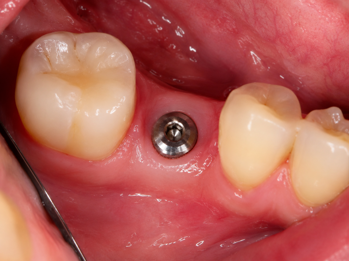 Implant Dentistry