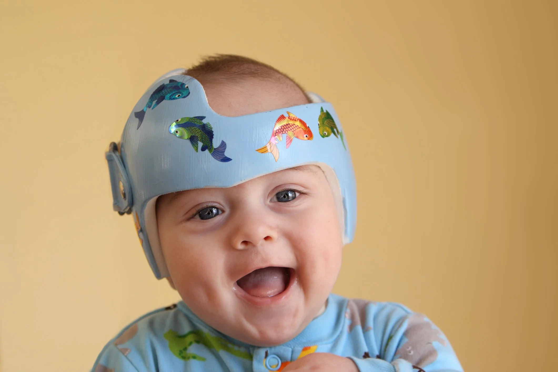 Plagiocephaly and brachycephaly helmets