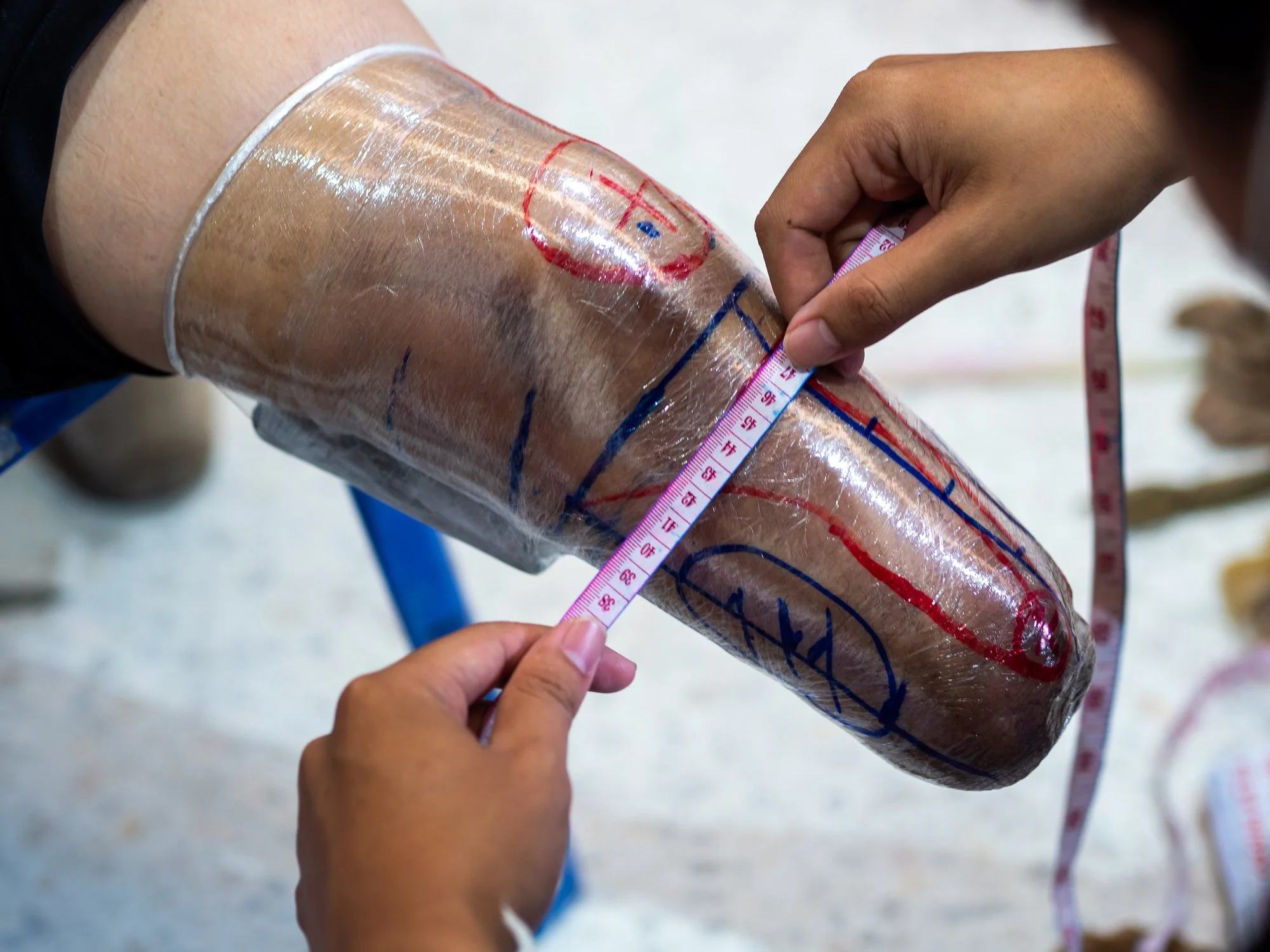 A person measuring a taped and marked plastic covering a leg (transtibial) amputation, for prosthetic socket casting.
