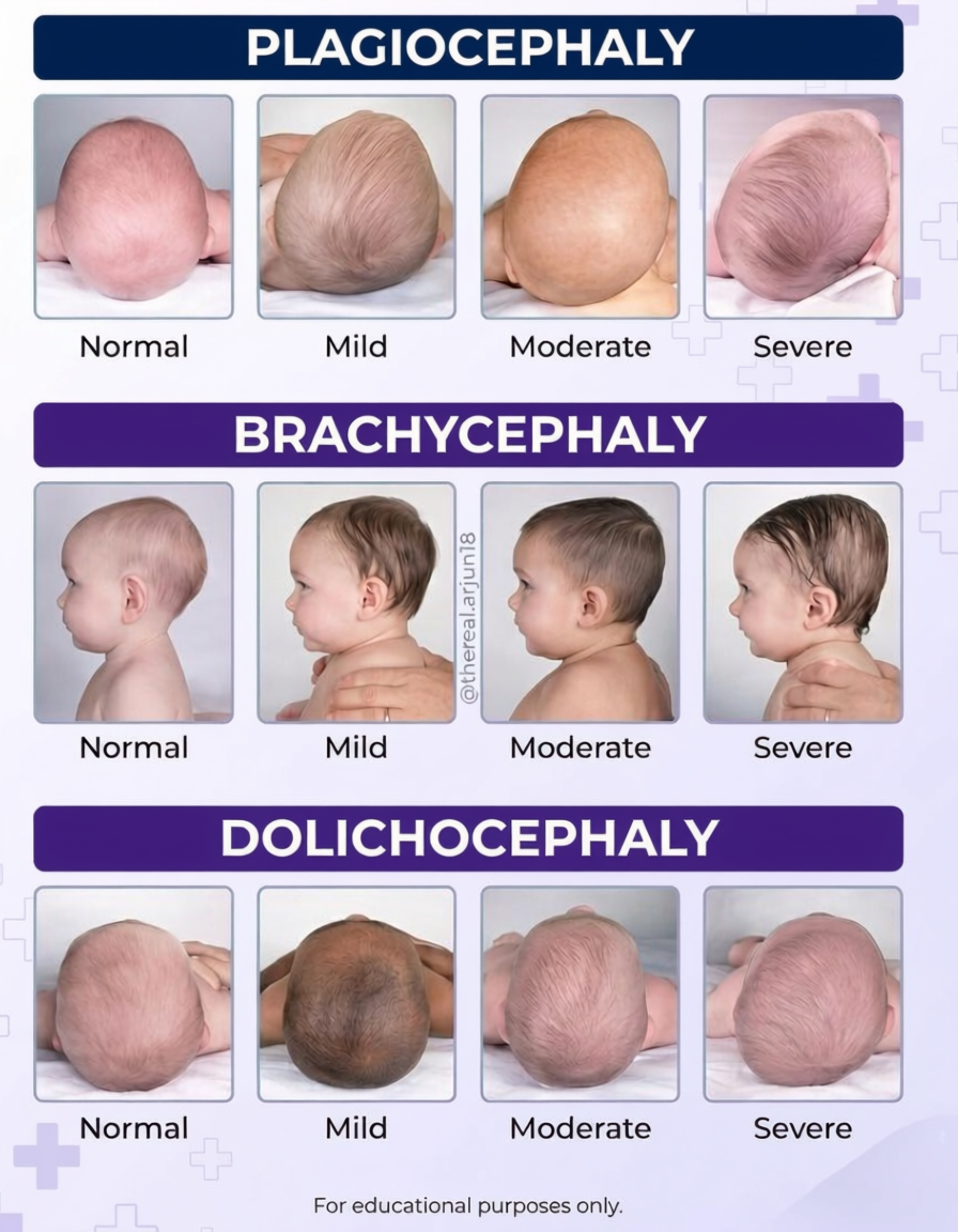 Chart showing different types of infant cranial deformities: Plagiocephaly, Brachycephaly, and Dolichocephaly, with images illustrating normal, mild, moderate, and severe cases for each condition.