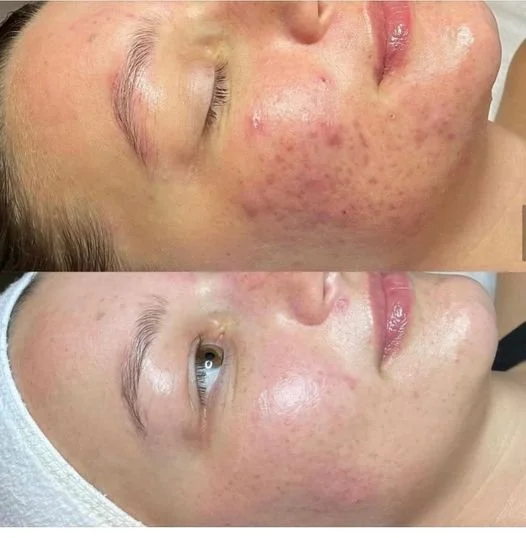 Close-up of a woman's face showing before and after skin treatment with visible improvement in redness and acne scars.