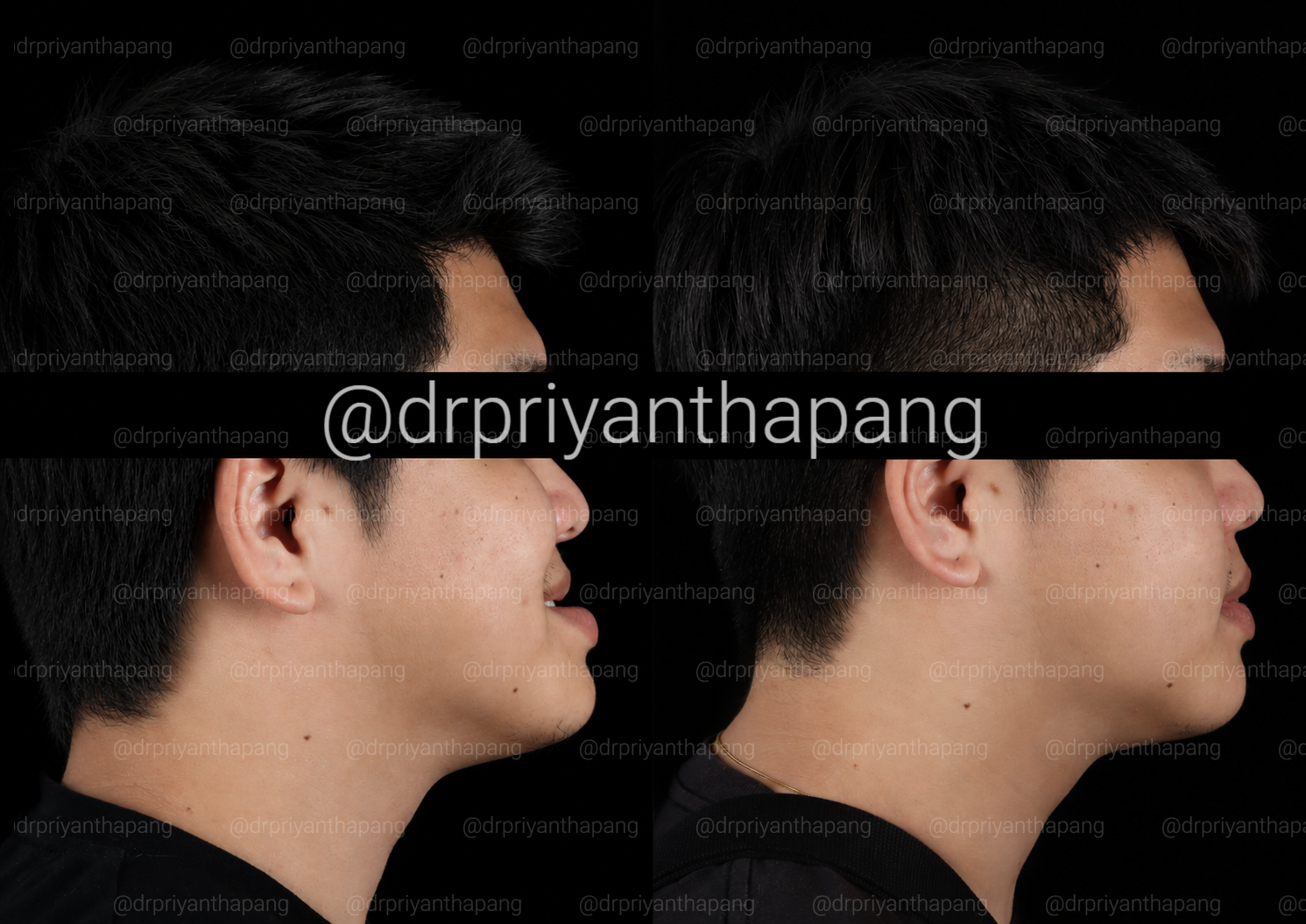 Before and after corrective jaw (orthognathic) surgery by Dr. Priyantha Pang, Oral and Maxillofacial Surgeon, correcting a Class III skeletal underbite to improve facial profile, bite alignment, and airway function with lefort I maxillary advancement