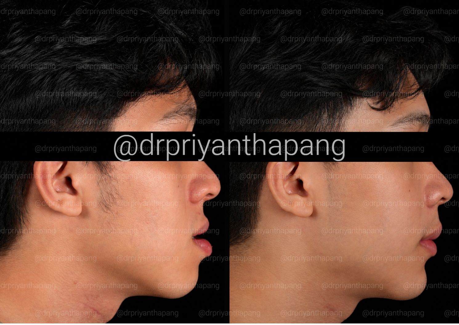 Before and after corrective jaw (orthognathic) surgery by Dr. Priyantha Pang, Oral and Maxillofacial Surgeon, correcting a Class III skeletal underbite to improve facial profile, bite alignment, and airway function with lefort I maxillary advancement