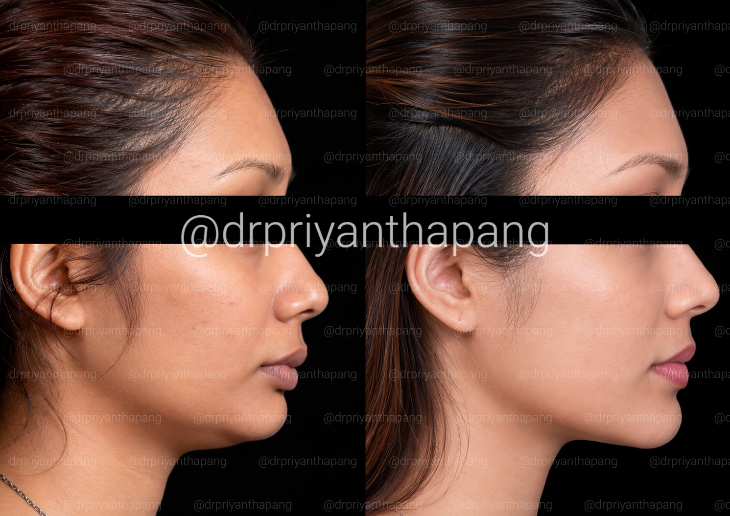 Before and after maxillomandibular advancement (MMA) corrective jaw surgery by Dr. Priyantha Pang, Oral and Maxillofacial Surgeon, correcting a Class II skeletal overbite with a weak chin to improve facial profile, bite alignment, and obstructive sle