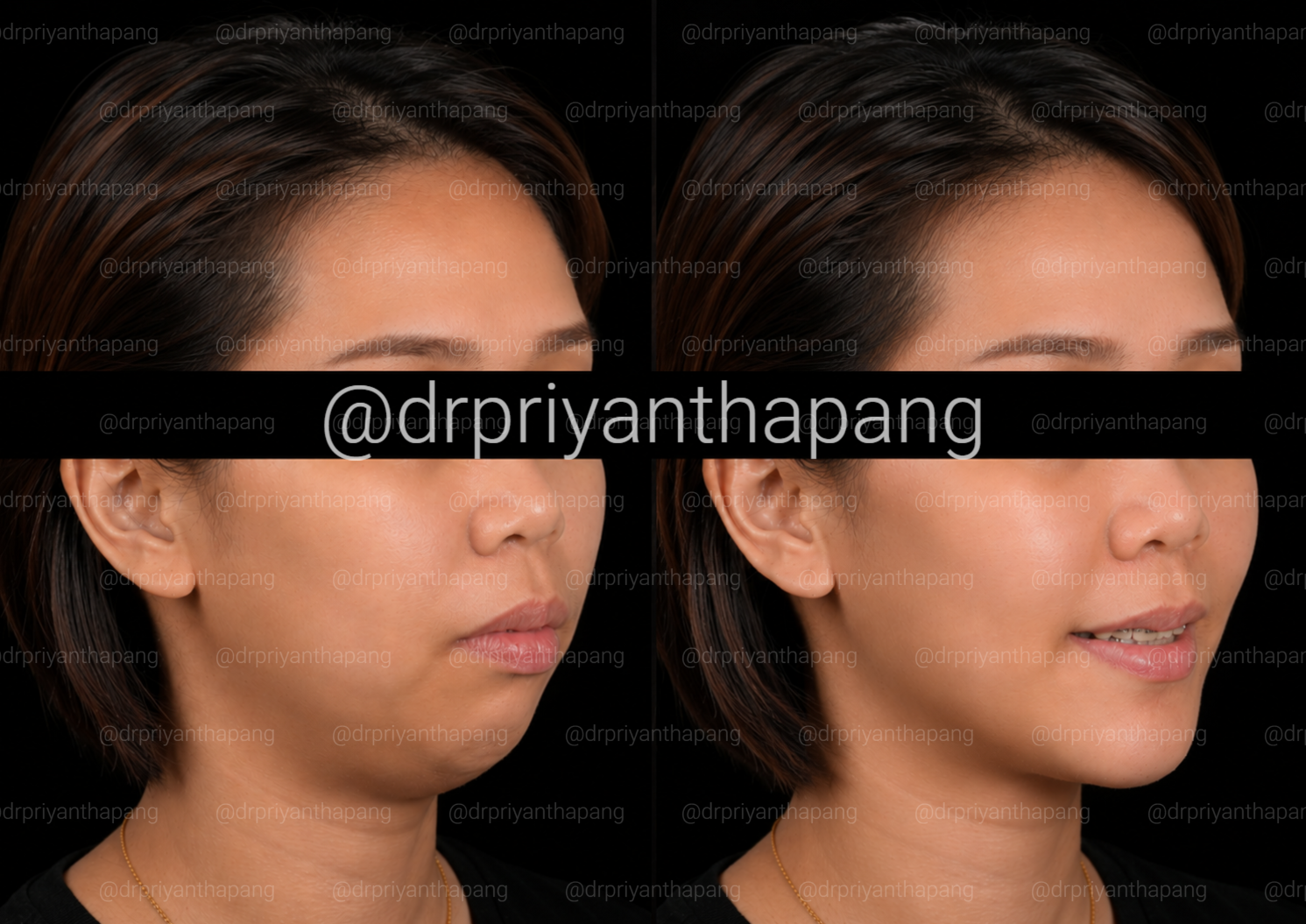 Before and after maxillomandibular advancement (MMA) surgery by Dr. Priyantha Pang, Oral and Maxillofacial Surgeon, correcting a Class II skeletal overbite with a weak chin to improve facial profile, bite alignment, and obstructive sleep apnea.