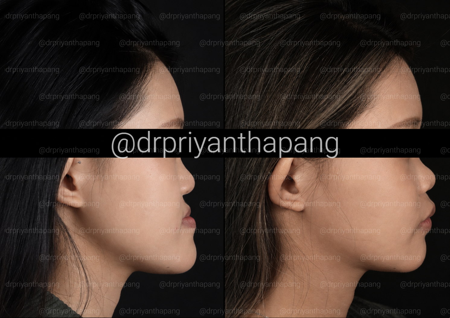 Before and after corrective jaw (orthognathic) surgery by Dr. Priyantha Pang, Oral and Maxillofacial Surgeon, correcting a Class III skeletal underbite to improve facial profile, bite alignment, and airway function with lefort I maxillary advancement