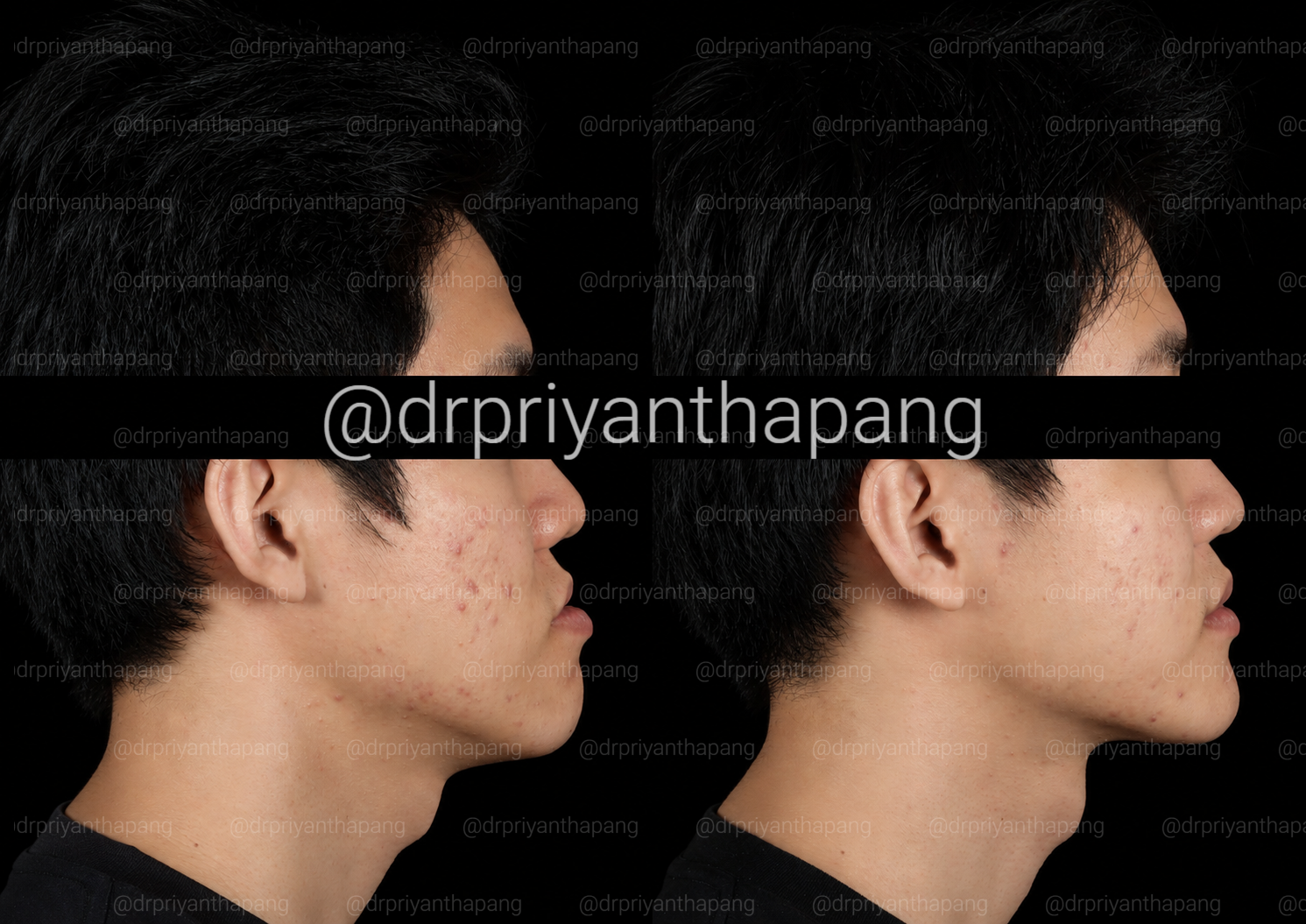 Before and after corrective jaw (orthognathic) surgery by Dr. Priyantha Pang, Oral and Maxillofacial Surgeon, correcting a Class III skeletal underbite to improve facial profile, bite alignment, and airway function with lefort I maxillary advancement