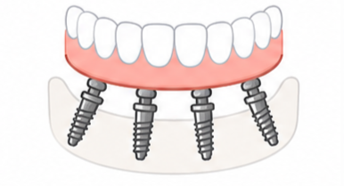 Full arch All-on-X dental implants replacing missing teeth