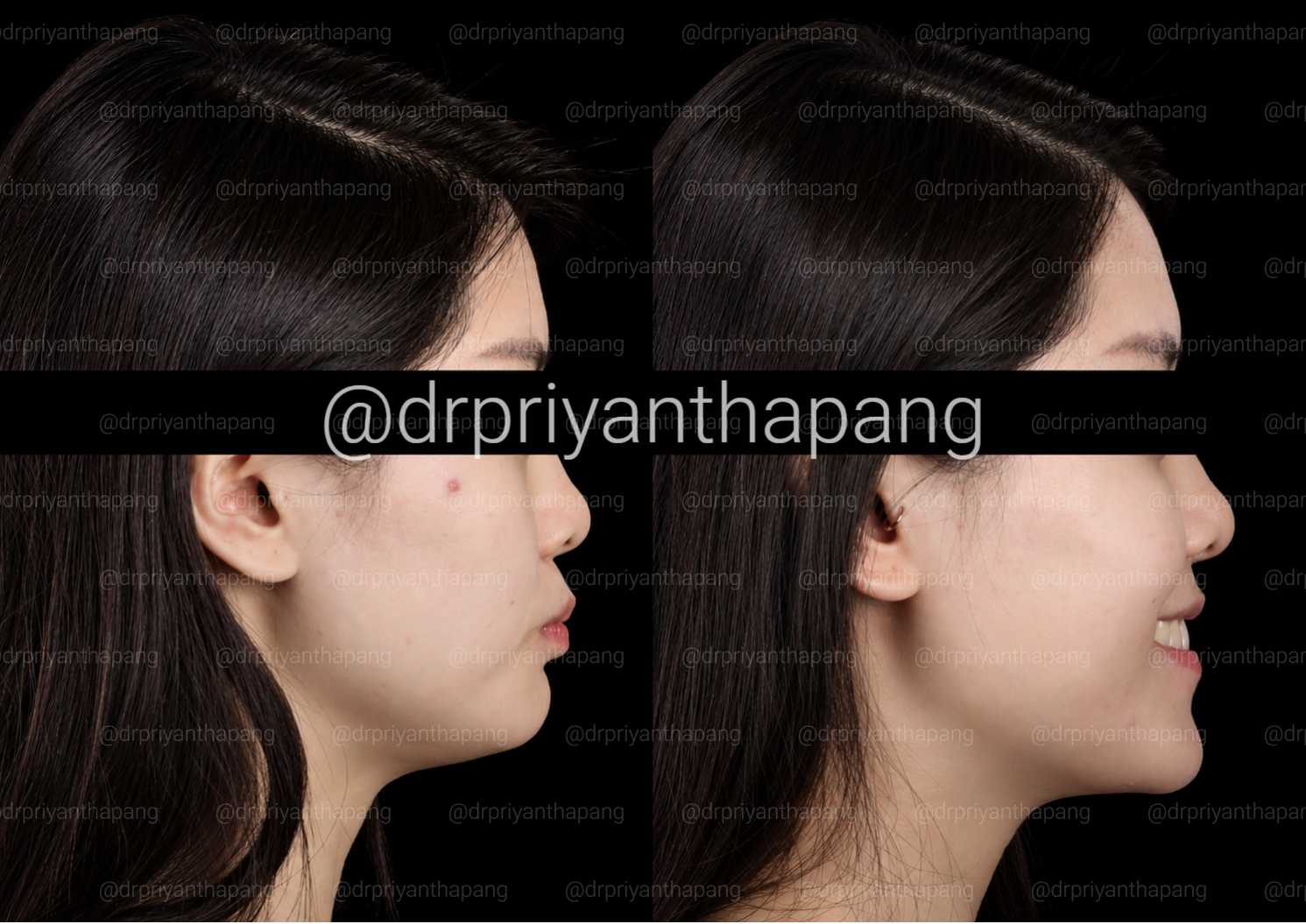 Before and after jaw advancement orthognathic surgery and genioplasty by Dr. Priyantha Pang, Oral and Maxillofacial Surgeon, correcting a Class II skeletal overbite with a weak chin to improve facial profile, bite alignment, and obstructive sleep apn