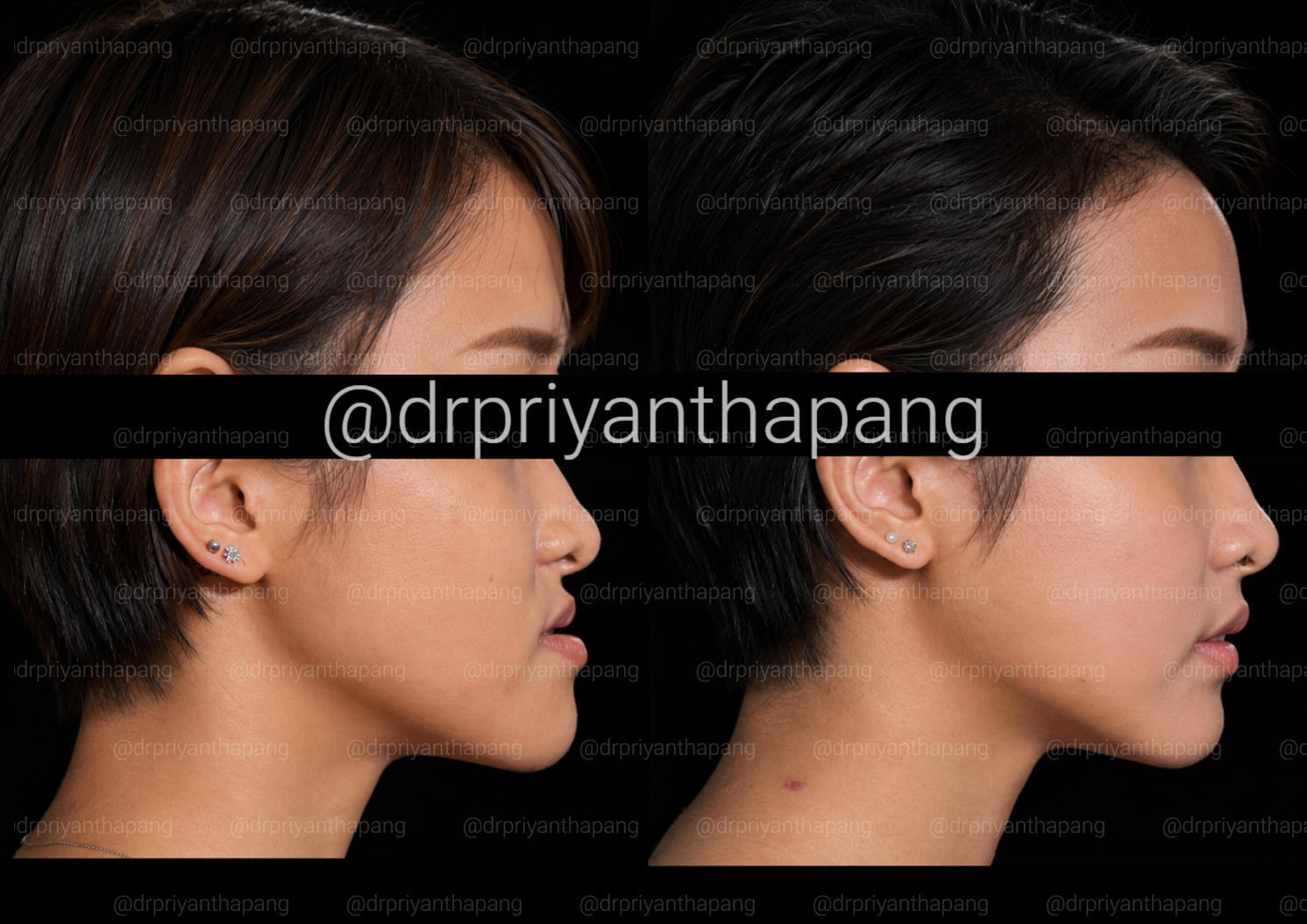 Before and after corrective jaw (orthognathic) surgery by Dr. Priyantha Pang, Oral and Maxillofacial Surgeon, correcting a Class III skeletal underbite to improve facial profile, bite alignment, and airway function with lefort I maxillary advancement