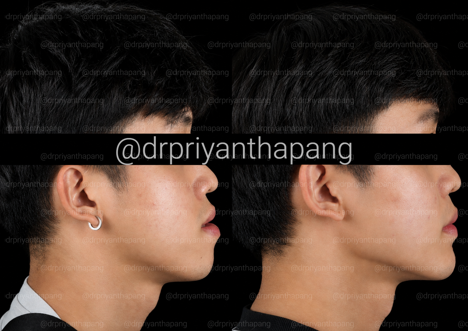 Before and after corrective jaw (orthognathic) surgery by Dr. Priyantha Pang, Oral and Maxillofacial Surgeon, correcting a Class III skeletal underbite to improve facial profile, bite alignment, and airway function with lefort I maxillary advancement