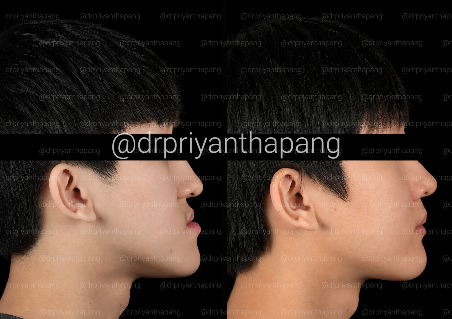 Before and after corrective jaw (orthognathic) surgery by Dr. Priyantha Pang, Oral and Maxillofacial Surgeon, correcting a Class III skeletal underbite to improve facial profile, bite alignment, and airway function with lefort I maxillary advancement
