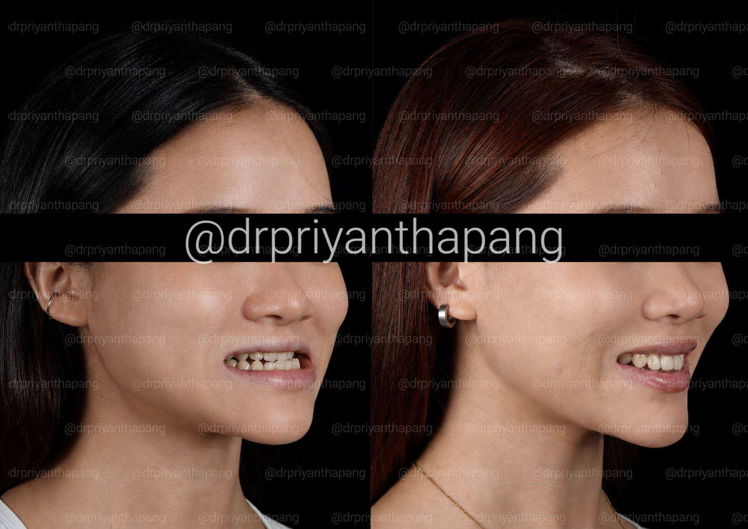 Before and after corrective jaw (orthognathic) surgery by Dr. Priyantha Pang, Oral and Maxillofacial Surgeon, correcting a Class III skeletal underbite to improve facial profile, bite alignment, and airway function with lefort I maxillary advancement