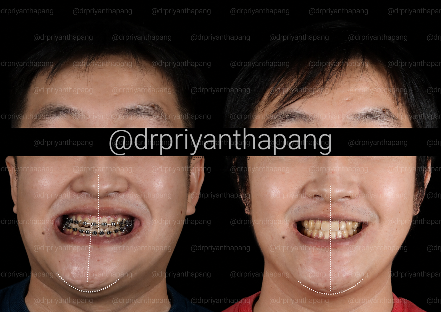 Before and after corrective jaw (orthognathic) surgery correcting facial assymmetry to improve facial symmetry, bite alignment, and airway function with Maxillary advancement and Mandibular setback and Genioplasty
by Dr. Priyantha Pang, Oral and Maxi
