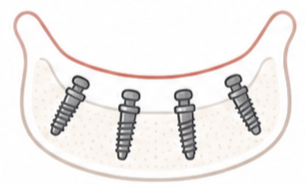 CBCT scan used for accurate All-on-X dental implant planning