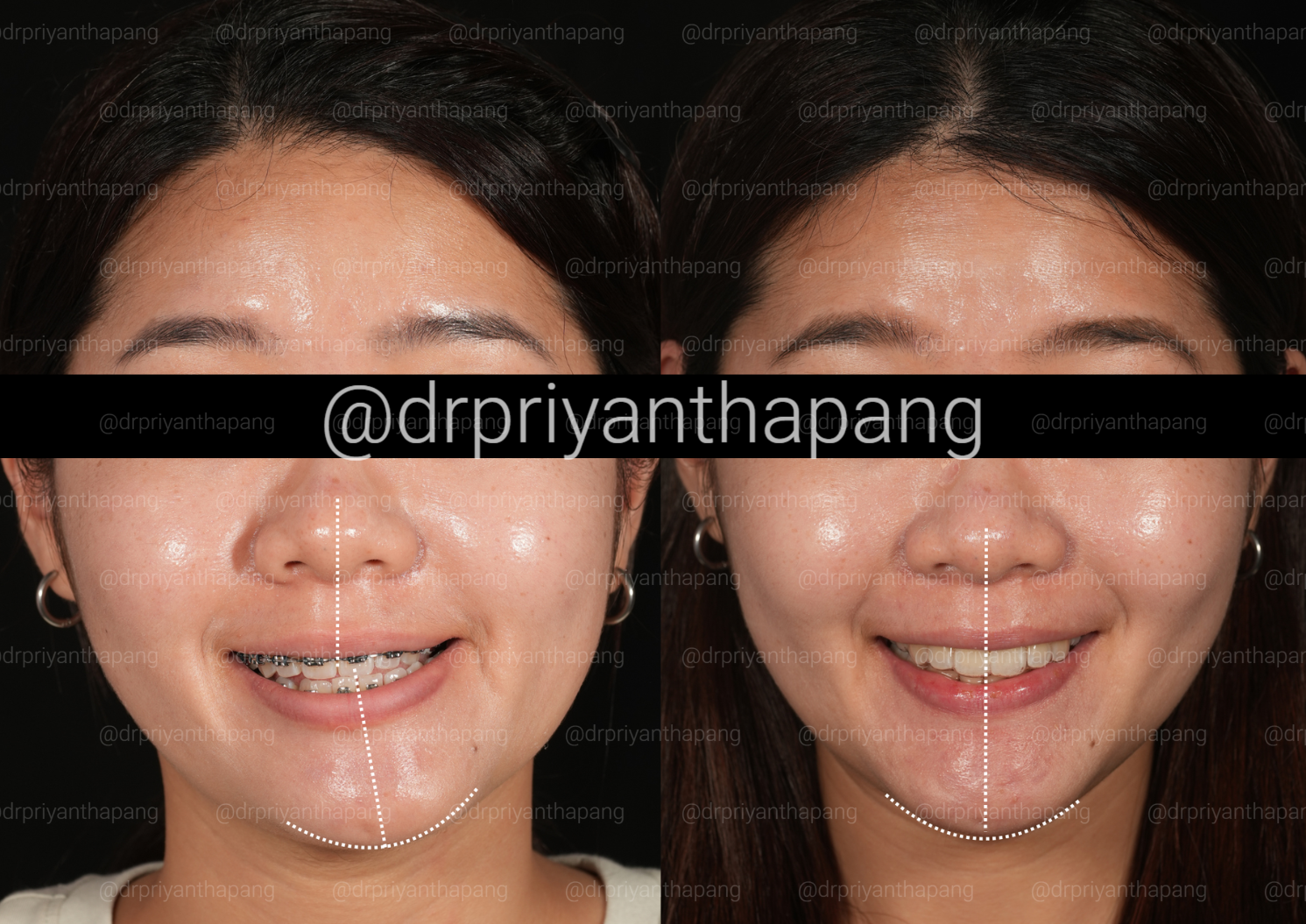 Before and after corrective jaw (orthognathic) surgery correcting facial assymmetry to improve facial profile, bite alignment, and airway function by Dr. Priyantha Pang, Oral and Maxillofacial Surgeon