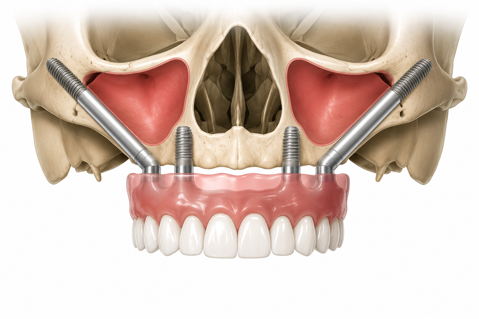 zygomatic implant pterygoid implant, lateral nasal implant, vomer implant