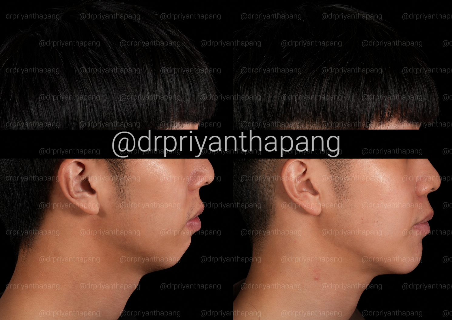 Before and after maxillomandibular advancement (MMA) orthognathic surgery by Dr. Priyantha Pang, Oral and Maxillofacial Surgeon, correcting a Class II skeletal overbite with a weak chin to improve facial profile, bite alignment, and obstructive sleep