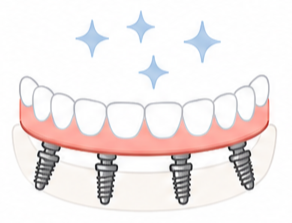 all on 4 or all on x dental implants supporting a full arch of Zirconia bridge, painless and one day smile