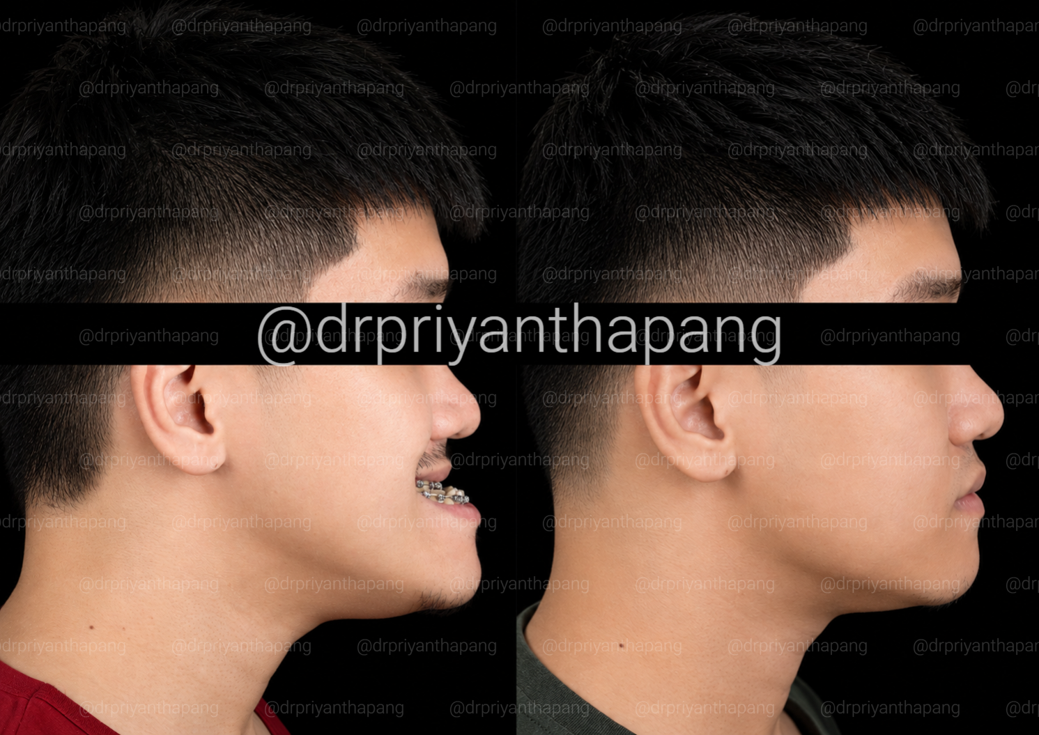 Before and after corrective jaw (orthognathic) surgery by Dr. Priyantha Pang, Oral and Maxillofacial Surgeon, correcting a Class III skeletal underbite to improve facial profile, bite alignment, and airway function with lefort I maxillary advancement