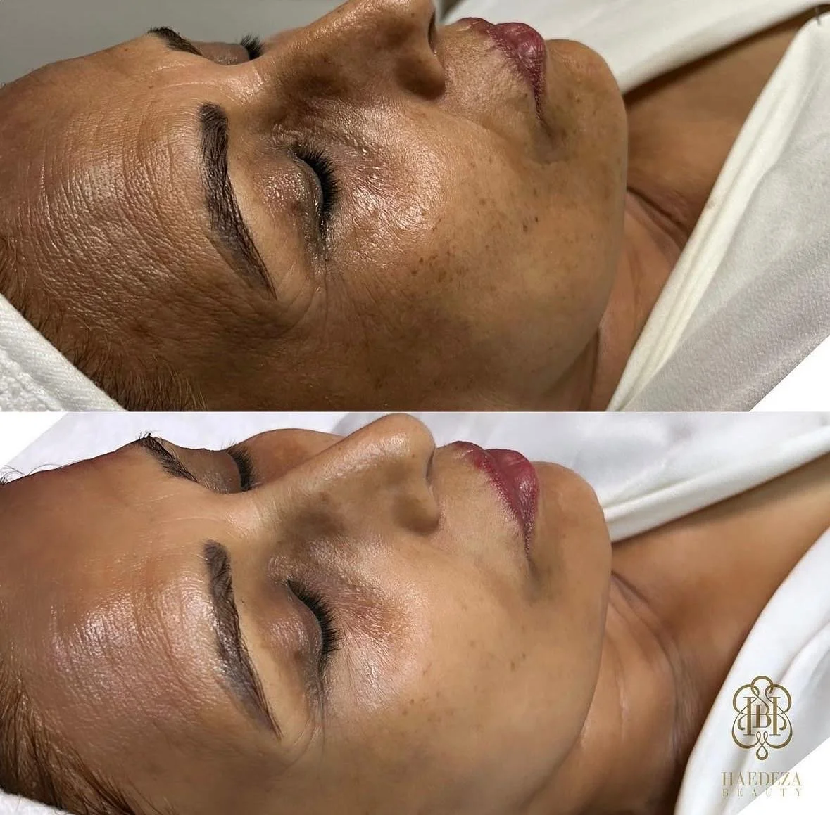 Vorher-Nachher-Bild einer Frau, die eine Gesichtsbehandlung erhält, mit klarer, glatter Haut nach der Behandlung.