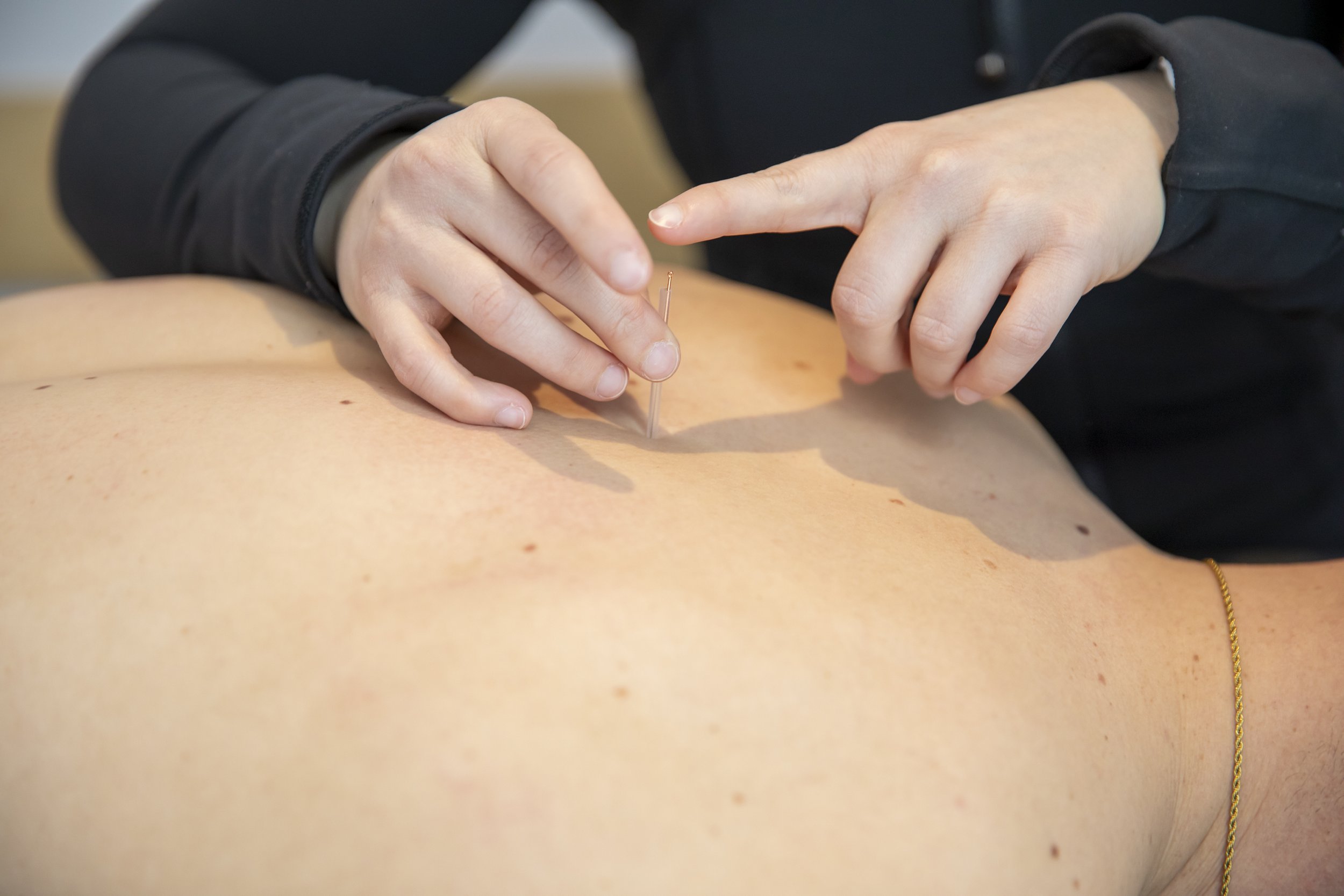 Une personne effectue une séance d'acupuncture sur une autre personne, insérant une aiguille fine dans la peau de cette dernière.