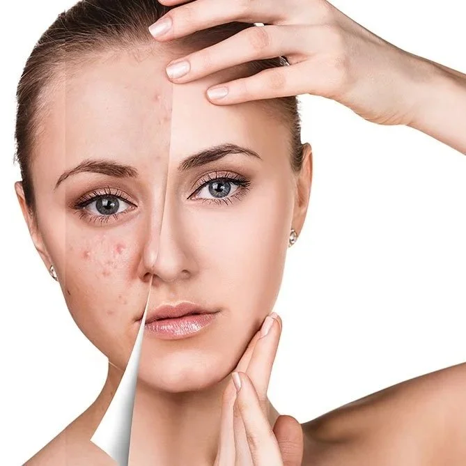 Teen acne facial providing deep pore cleansing, reduced breakouts, and healthier skin for adolescents.