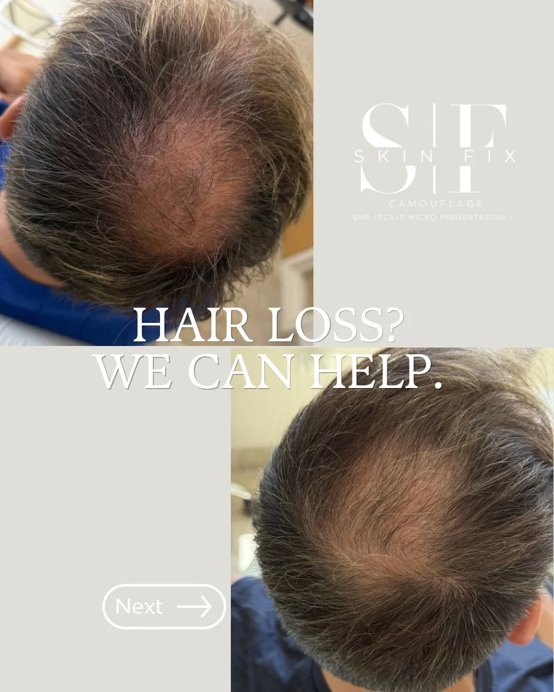 When it comes to hair loss, our goal isn&rsquo;t just to address what you see&mdash;it&rsquo;s to support a healthier scalp and the hair you still have.

Every treatment plan is customized because hair loss has many different causes. That&rsquo;s why