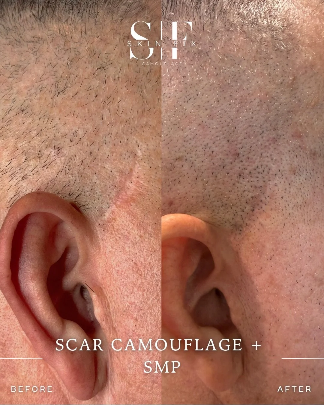 If you think you&rsquo;re stuck with your scar, DM us and let&rsquo;s see if we can prove you wrong. 

Scars need a treatment plan here is what we did for these surgical scars. 
We started with revision and camouflage and finished with Smp . Still he