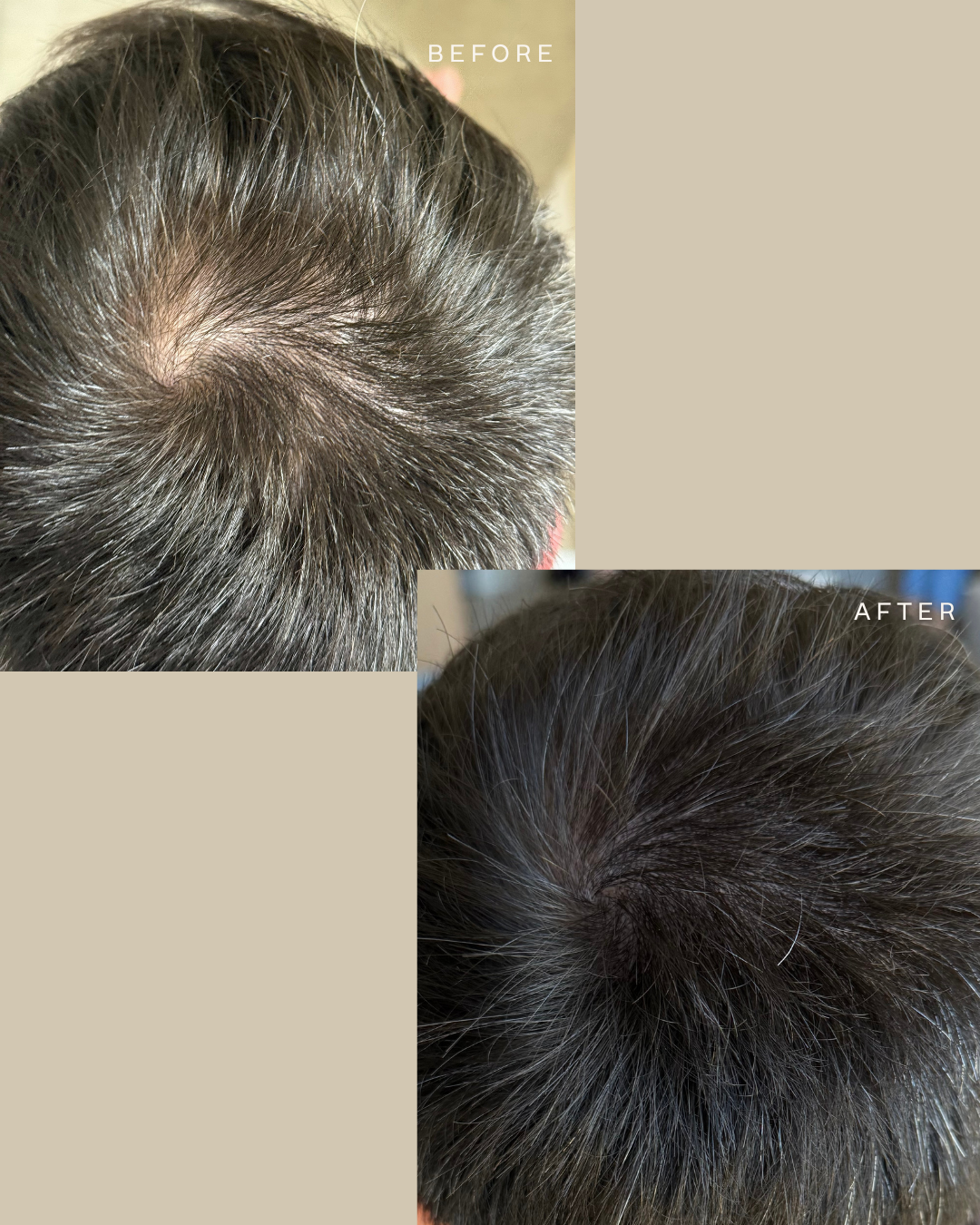 Comparison of a person's scalp showing hair thinning before and after treatment, with the 'before' image on the top left and the 'after' image on the bottom right.